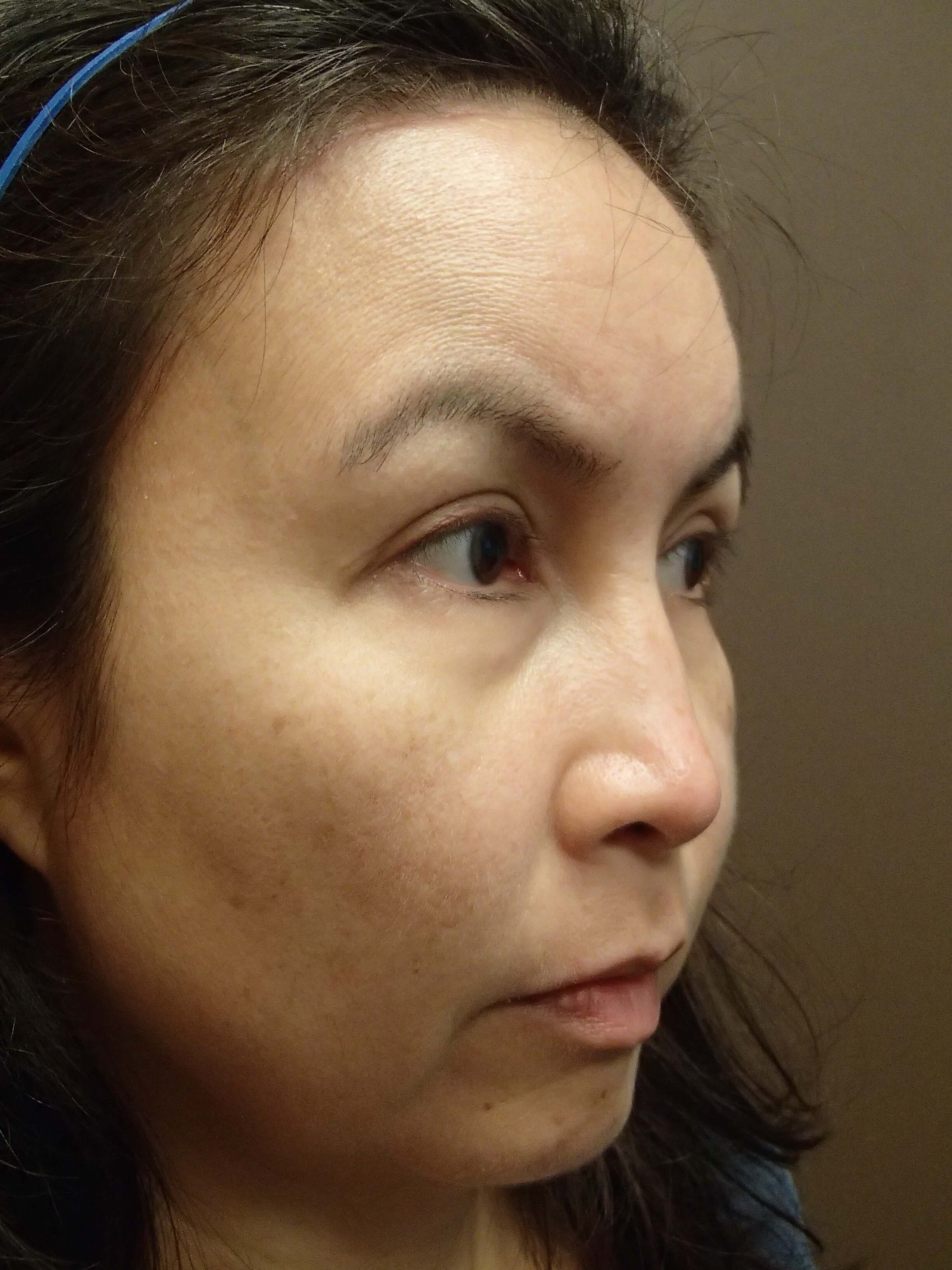 Blepharoplasty After