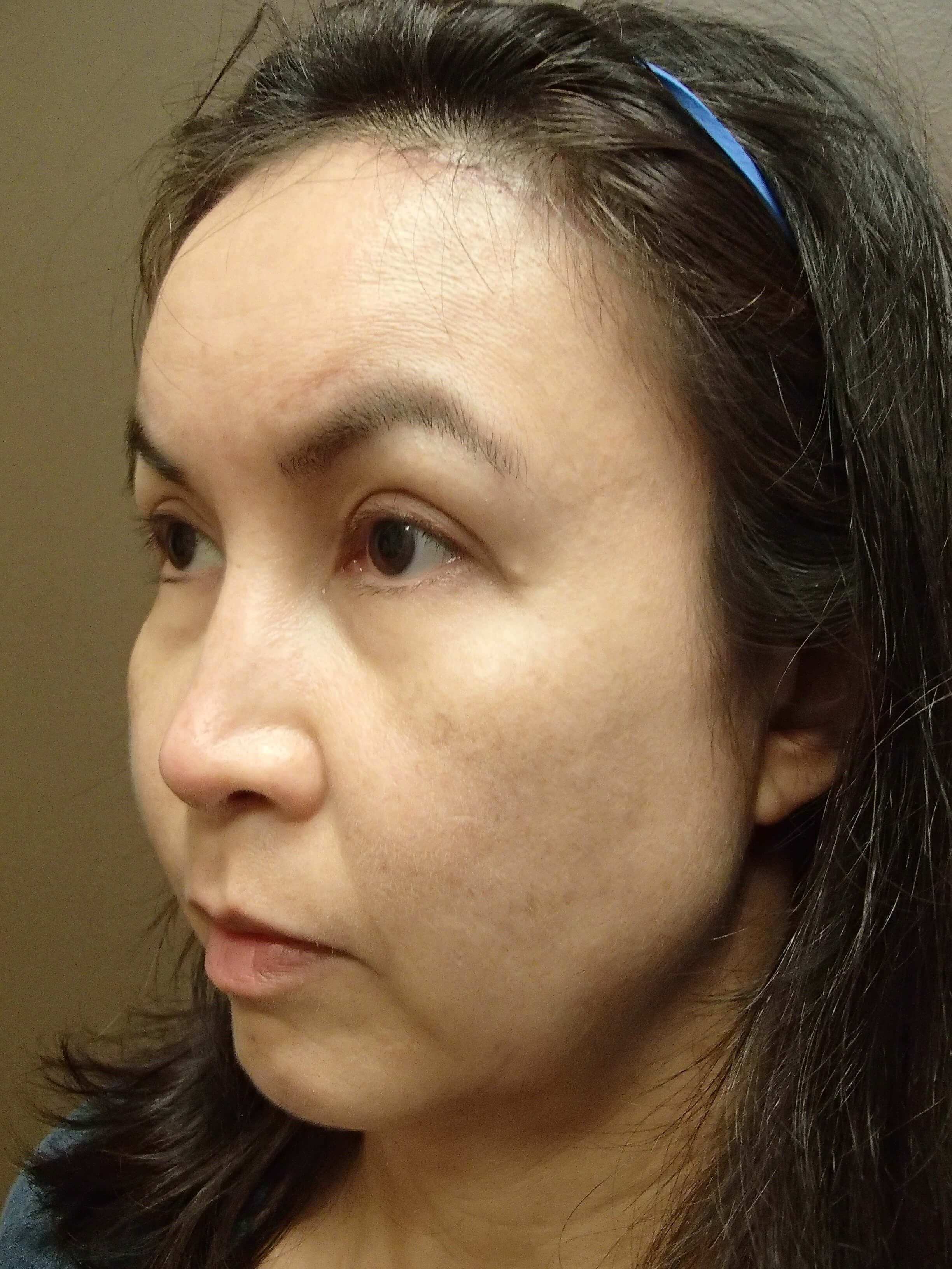 Blepharoplasty After