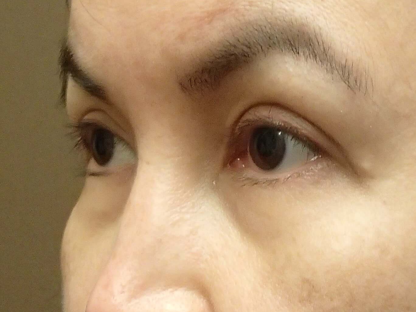 Blepharoplasty After