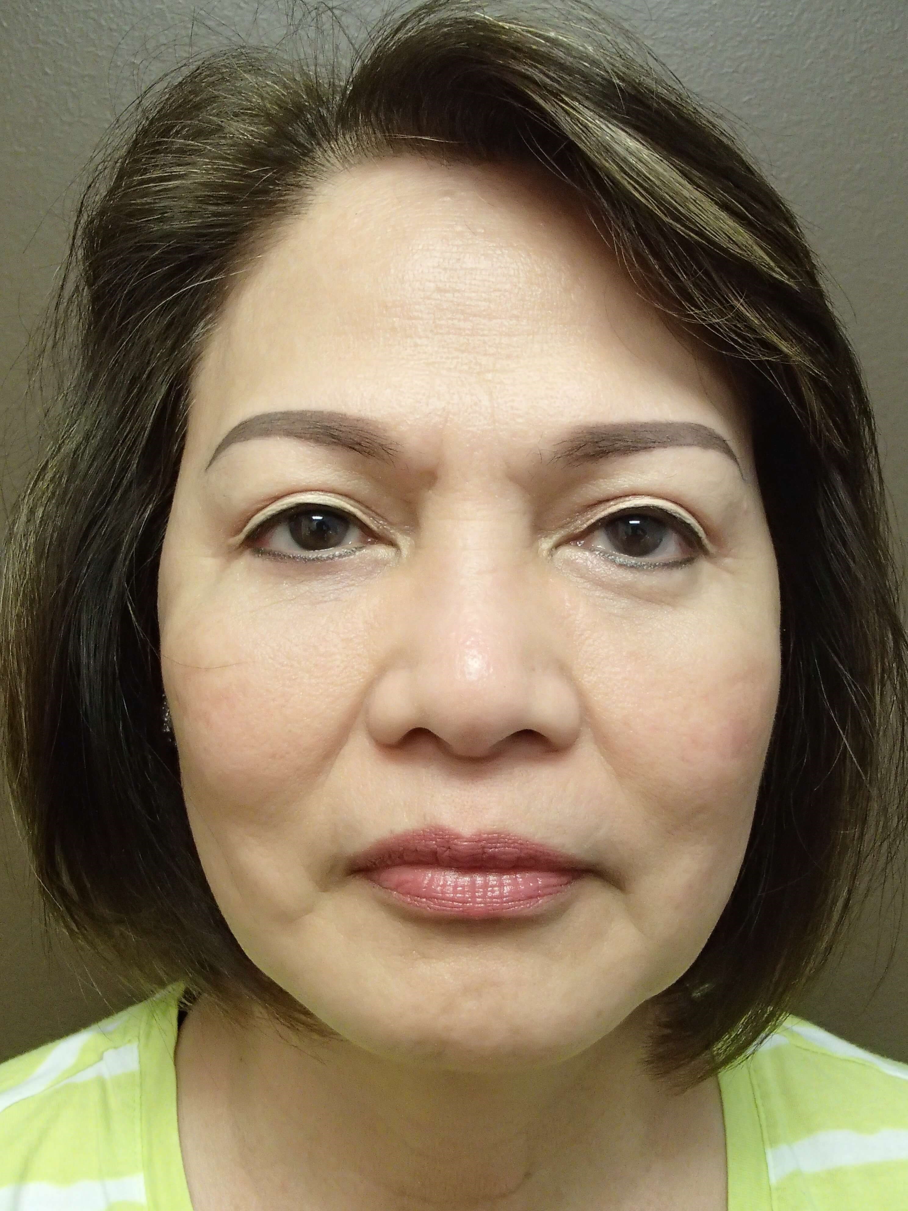 Blepharoplasty After