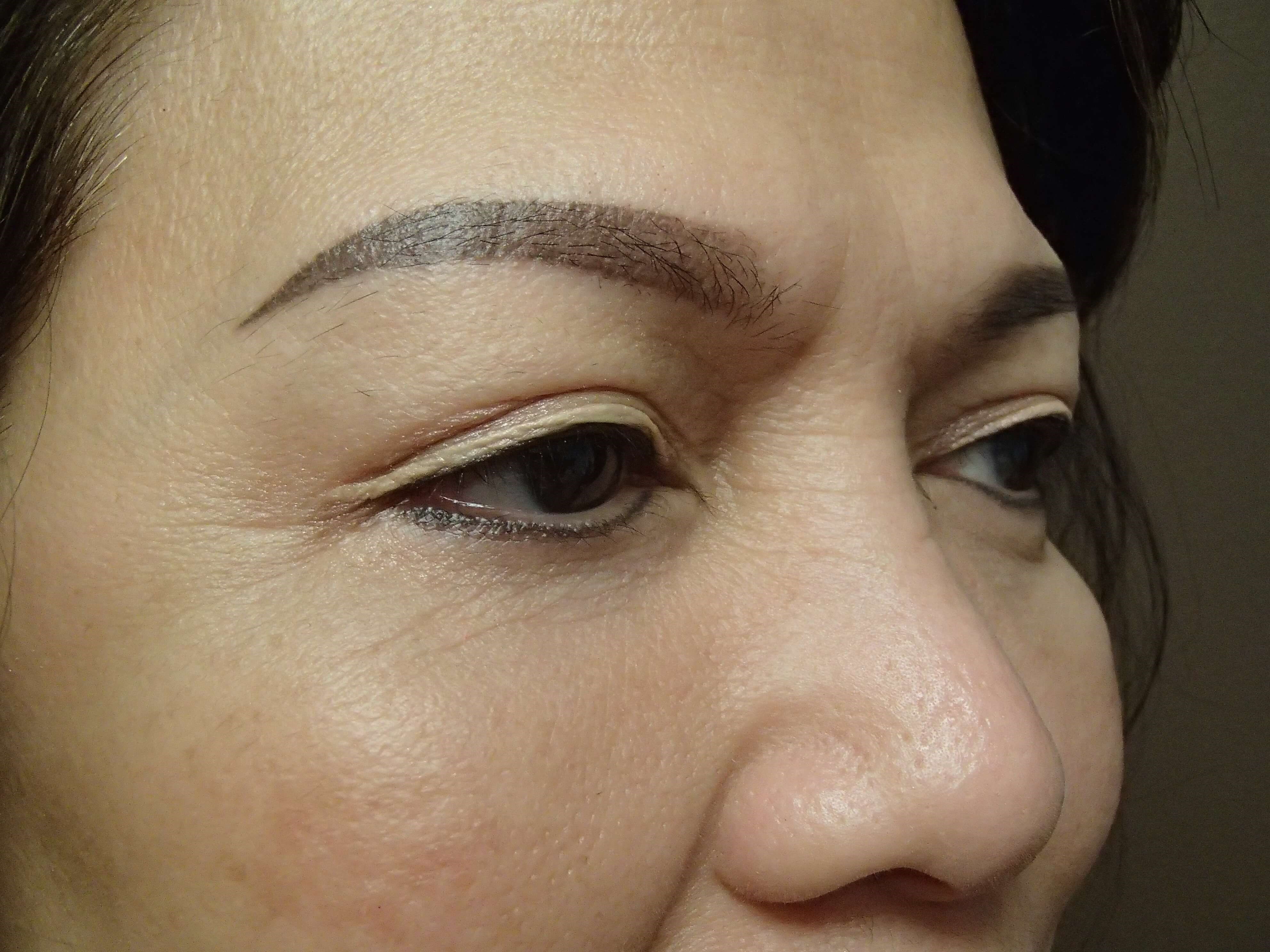 Blepharoplasty After