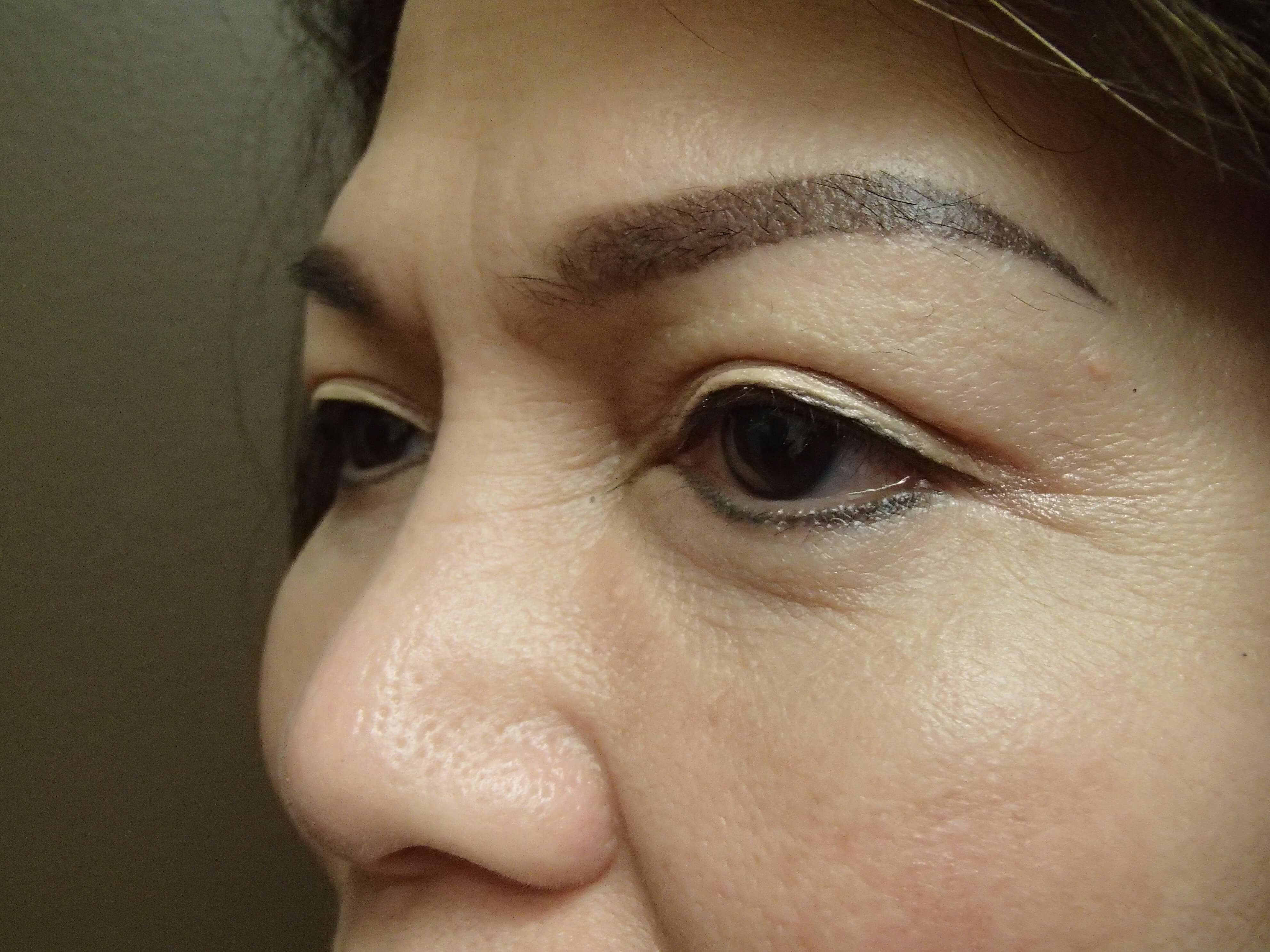 Blepharoplasty After