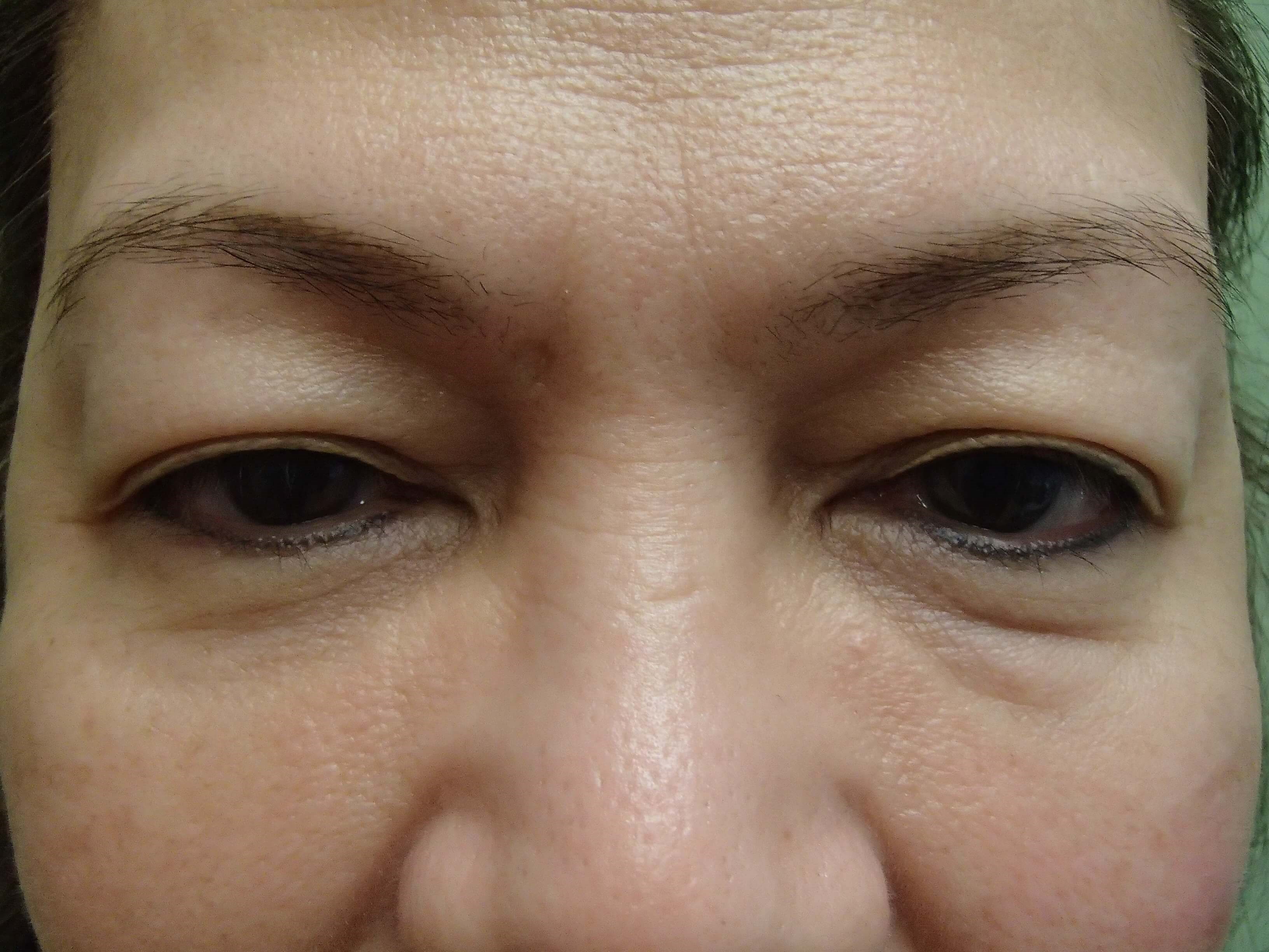 Blepharoplasty Before