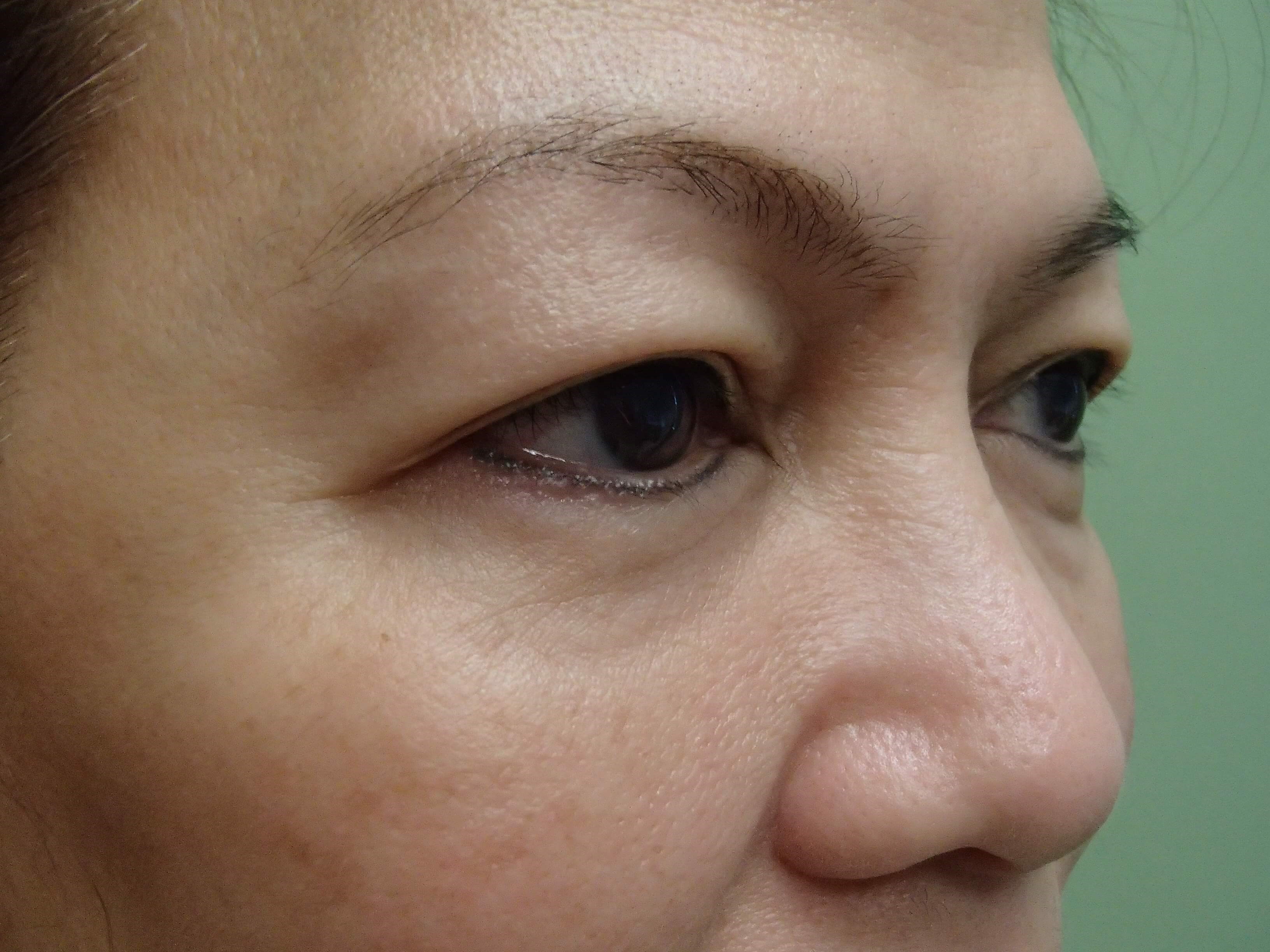 Blepharoplasty Before