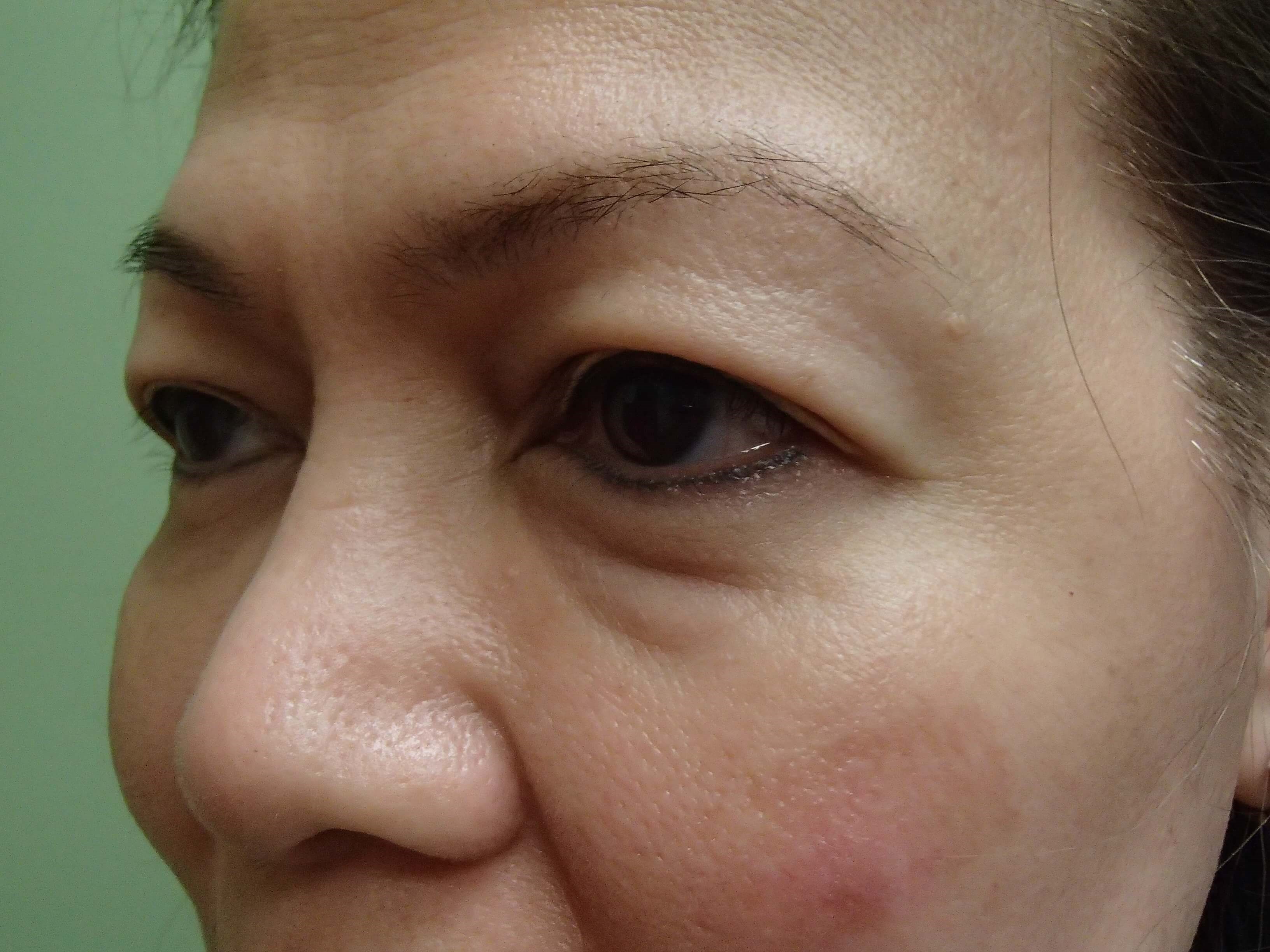 Blepharoplasty Before