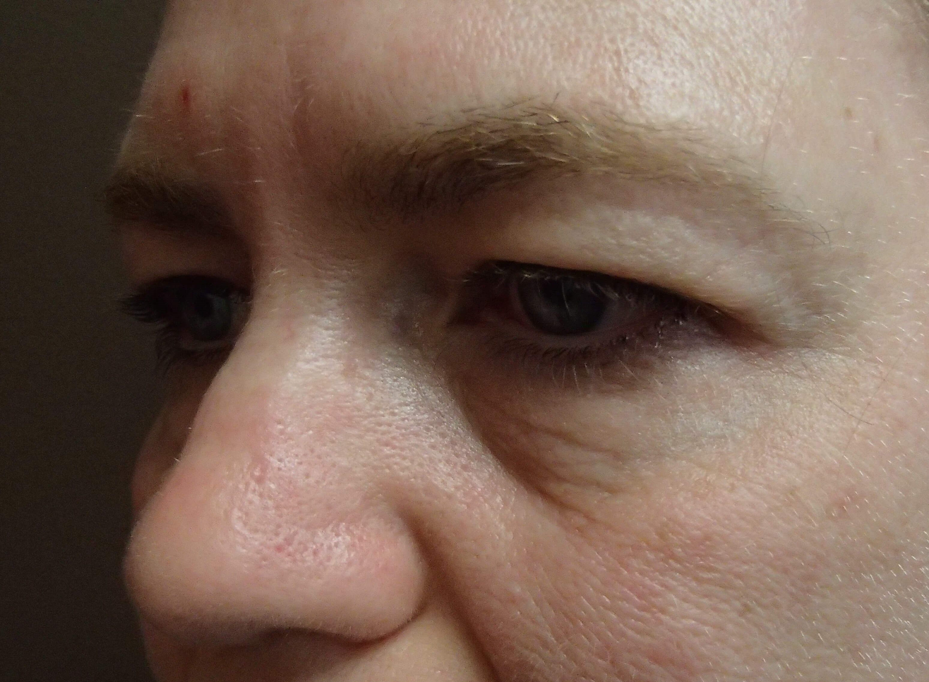 Blepharoplasty Before