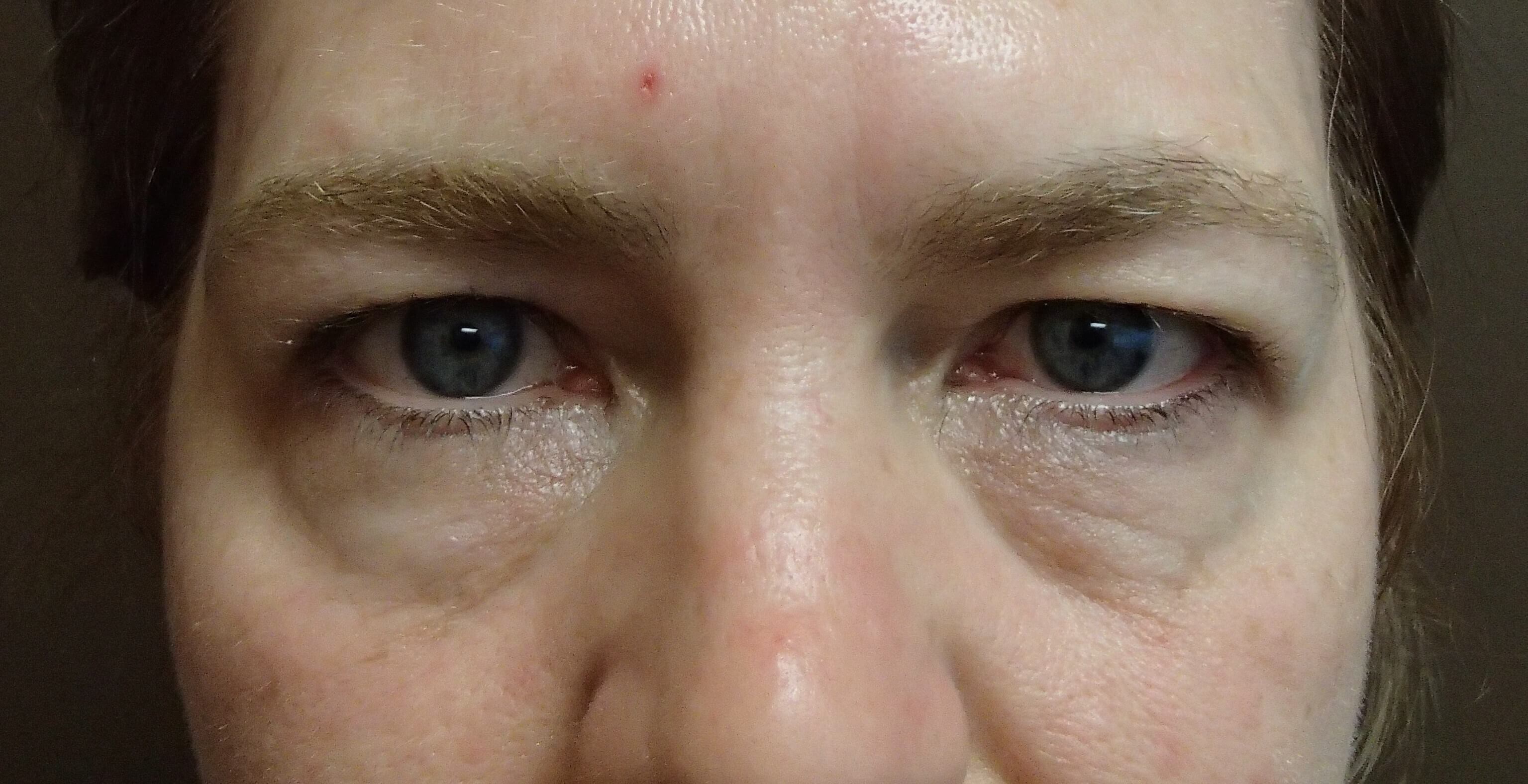 Blepharoplasty Before