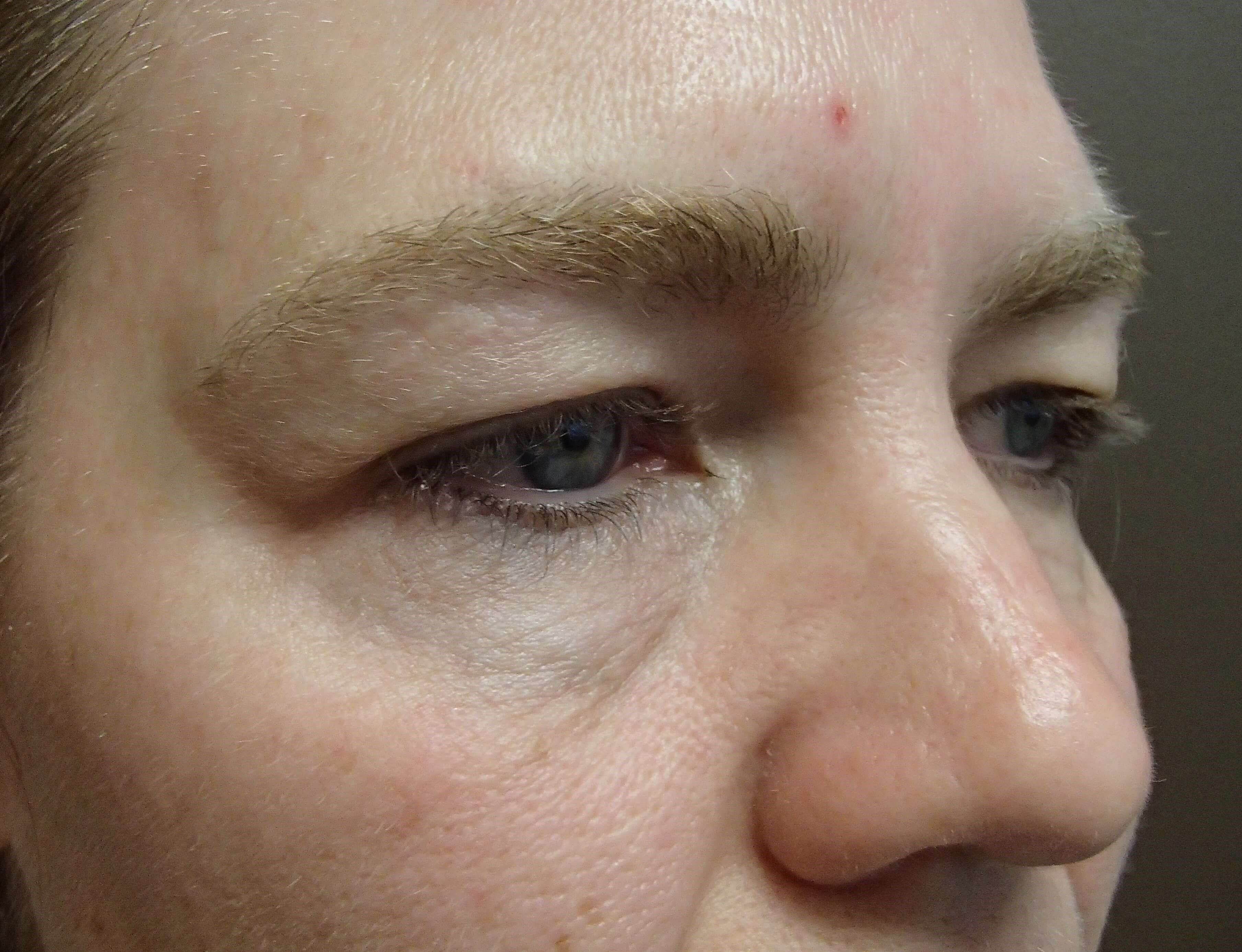 Blepharoplasty Before