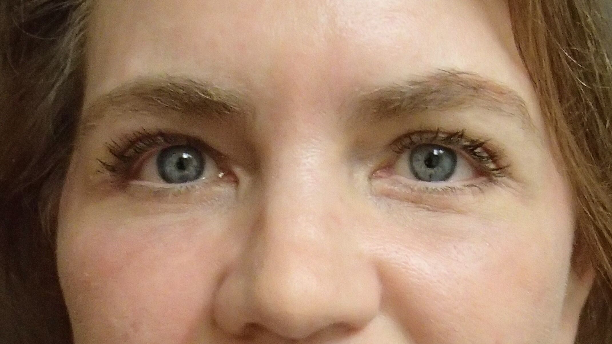 Blepharoplasty After