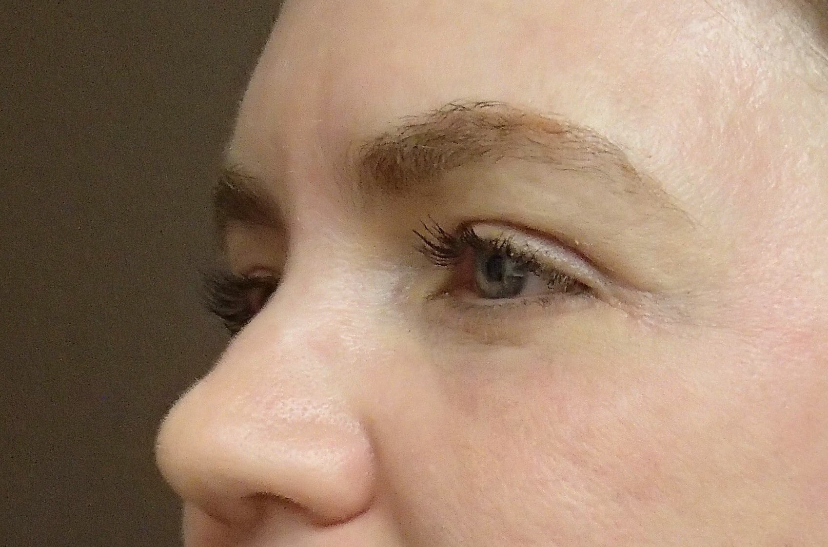 Blepharoplasty After
