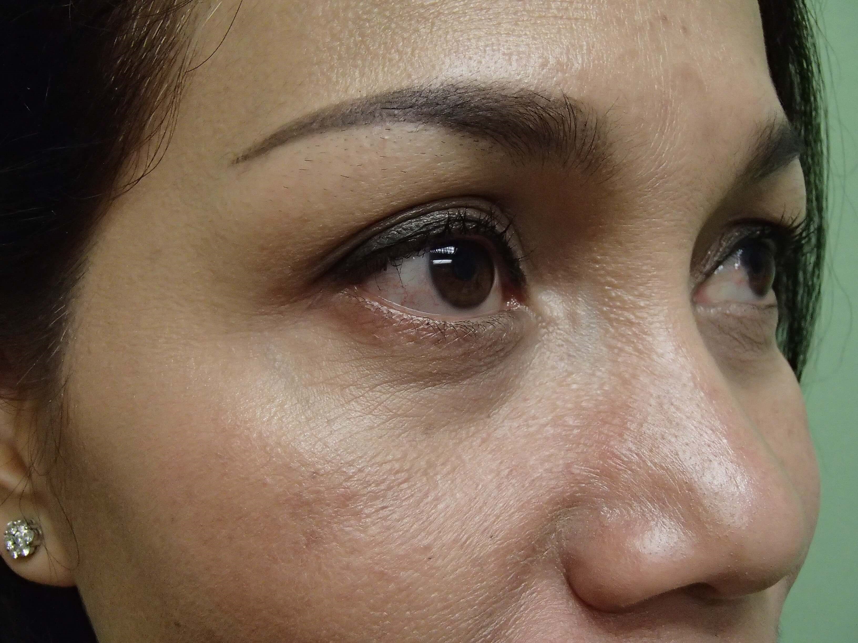 Blepharoplasty Before