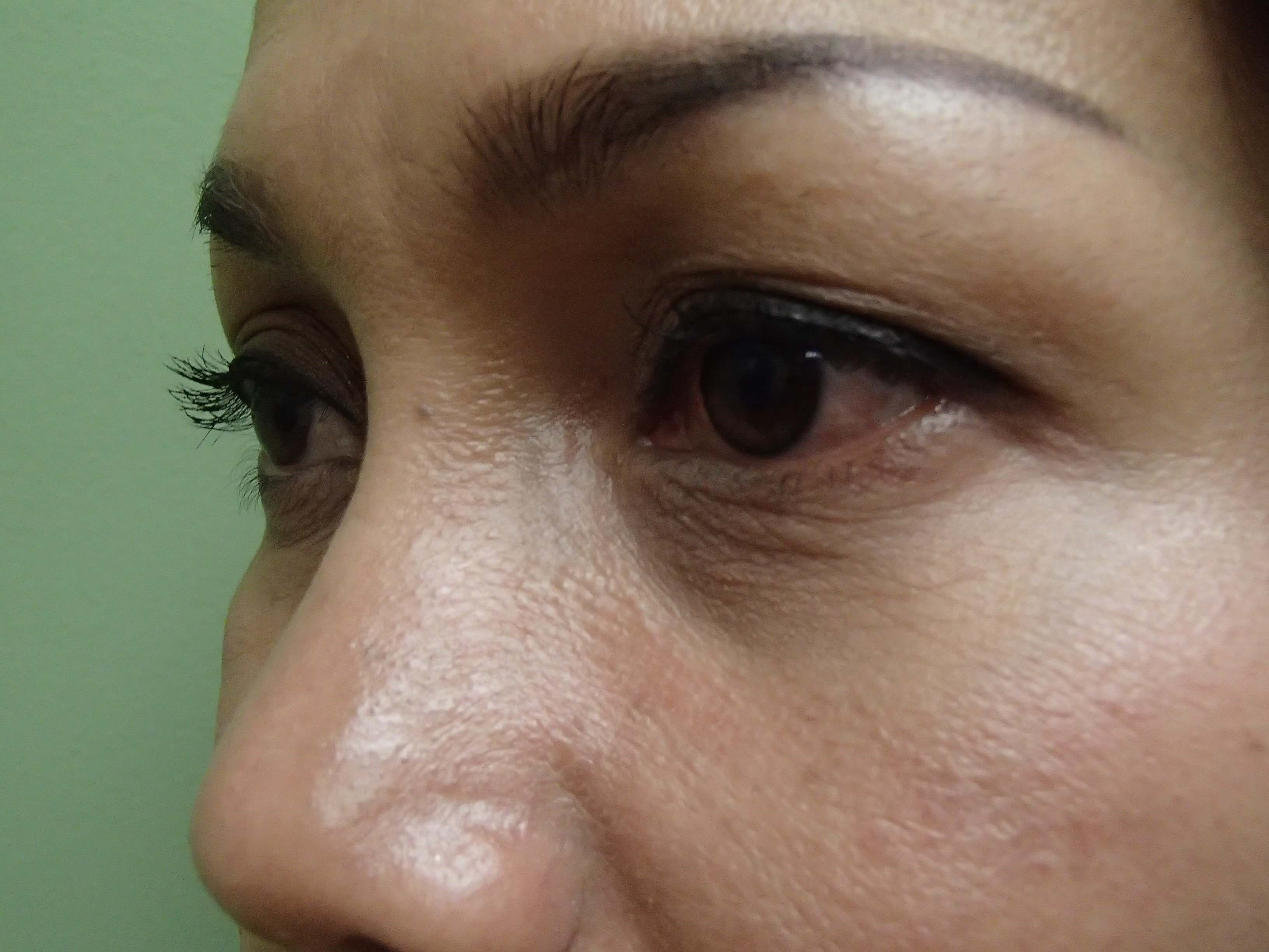 Blepharoplasty Before
