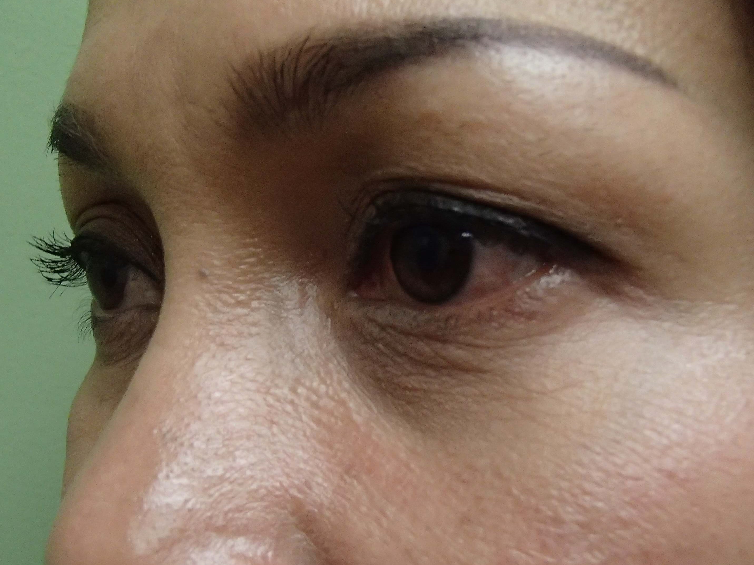 Blepharoplasty Before