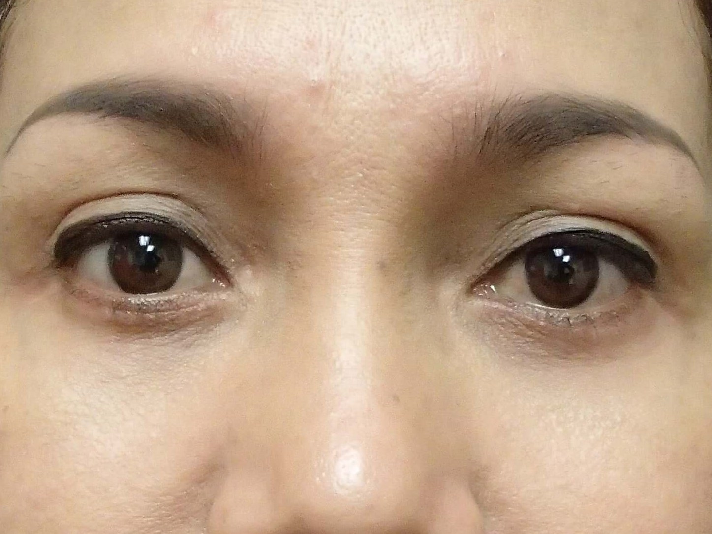 Blepharoplasty After