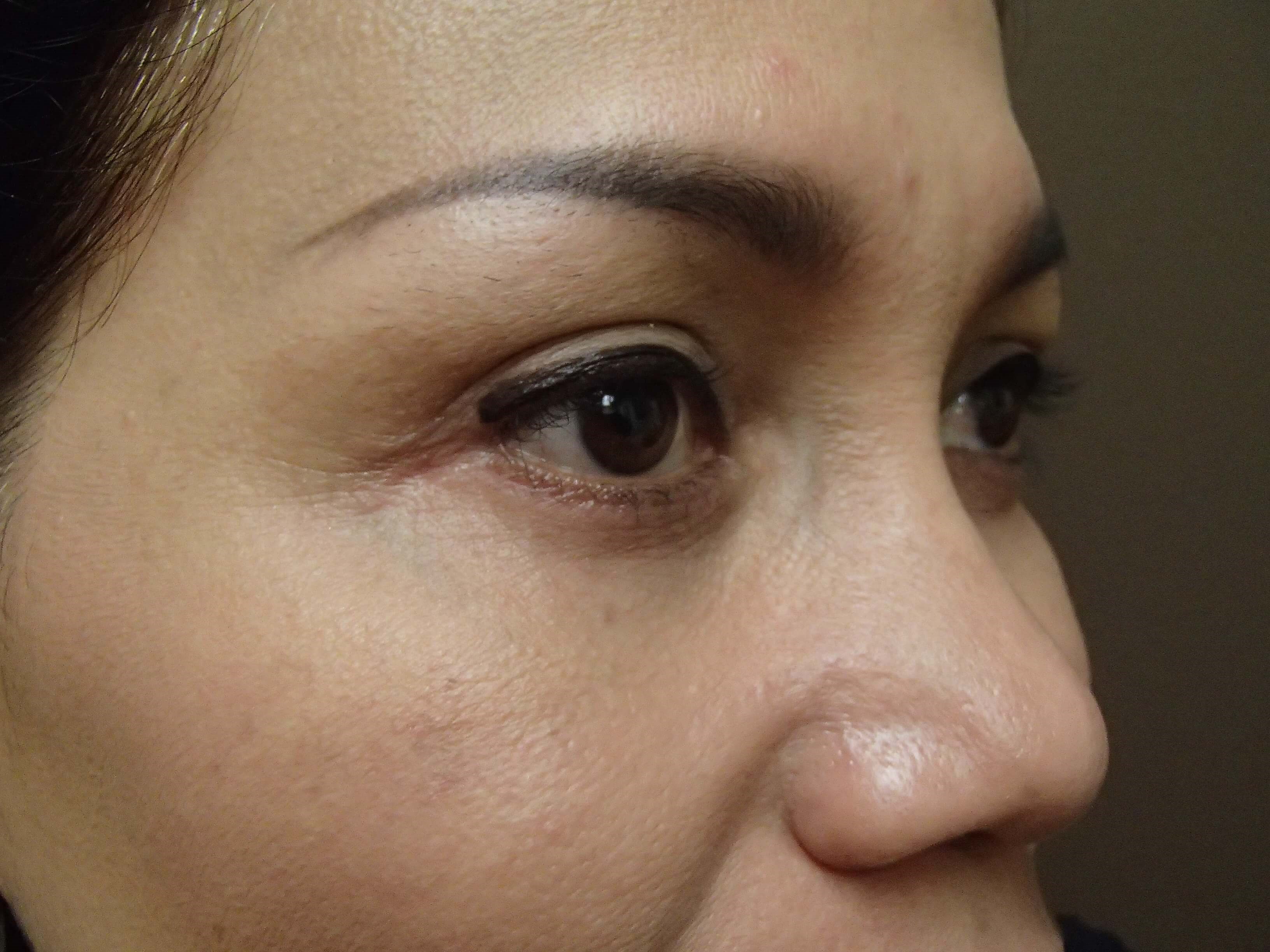 Blepharoplasty After