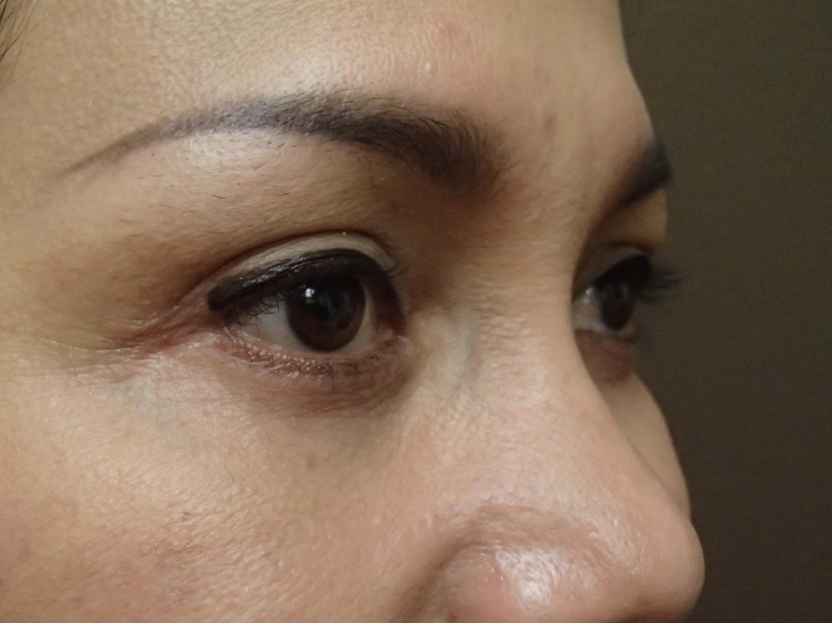 Blepharoplasty After