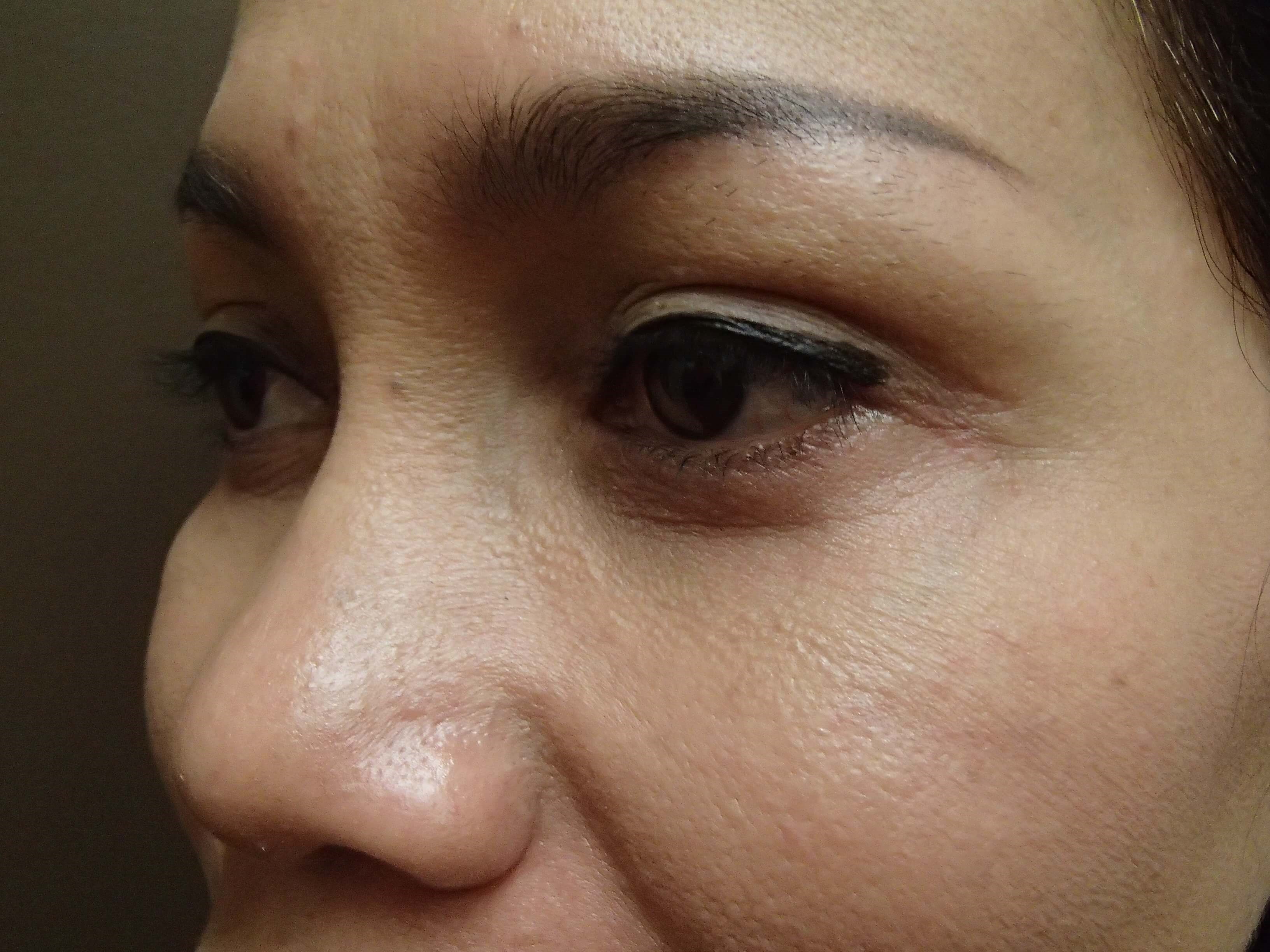 Blepharoplasty After