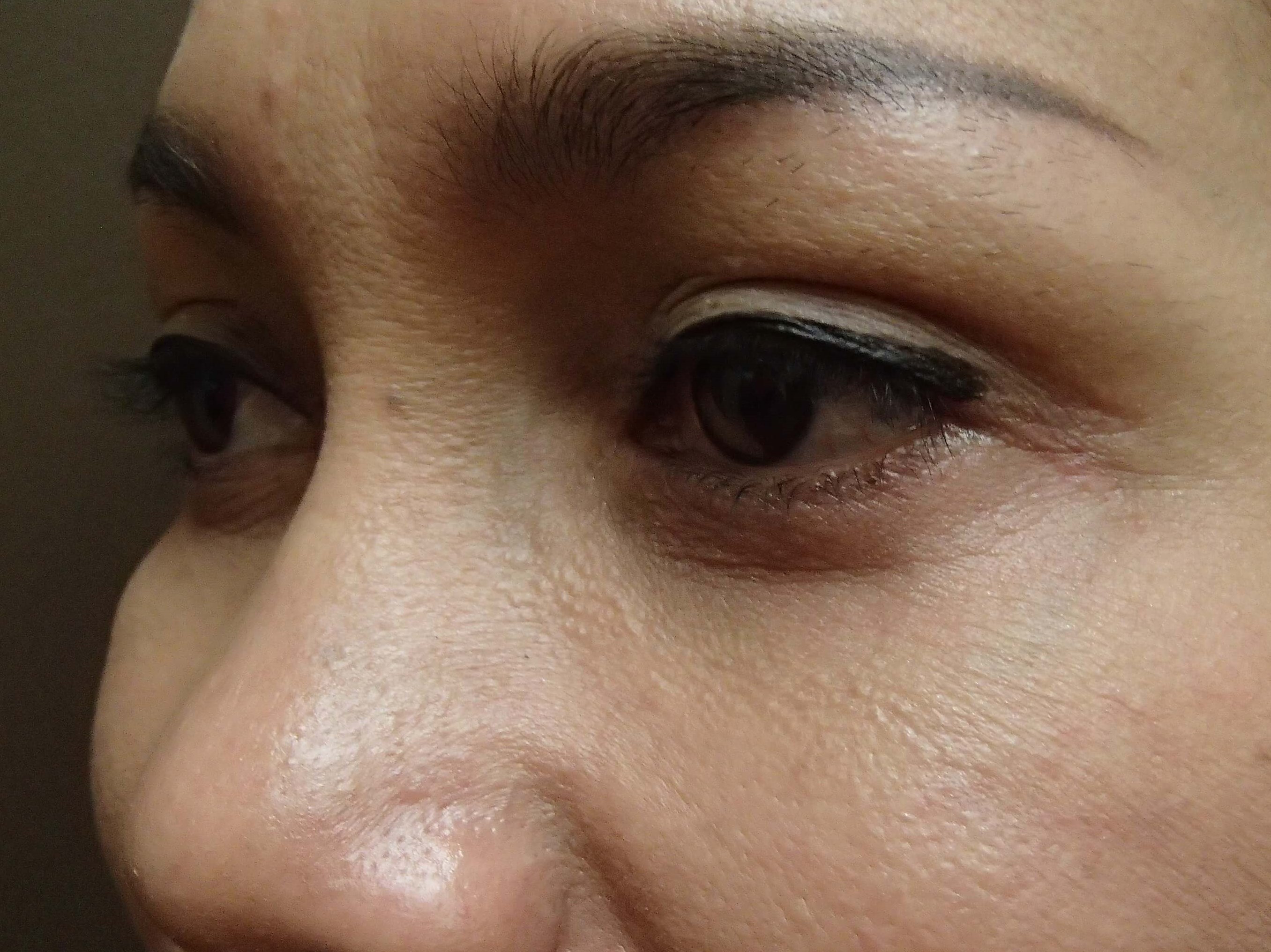 Blepharoplasty After