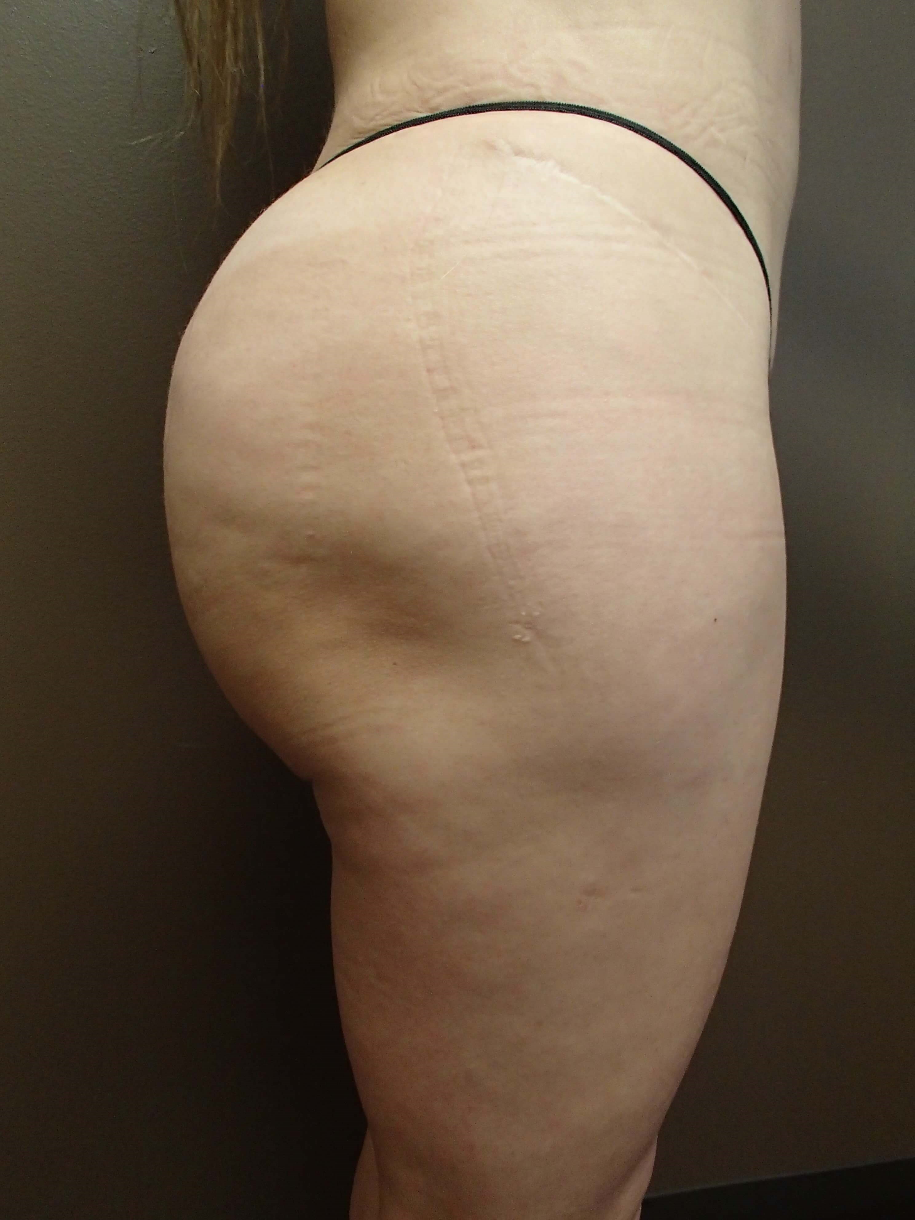 Buttock Augmentation After