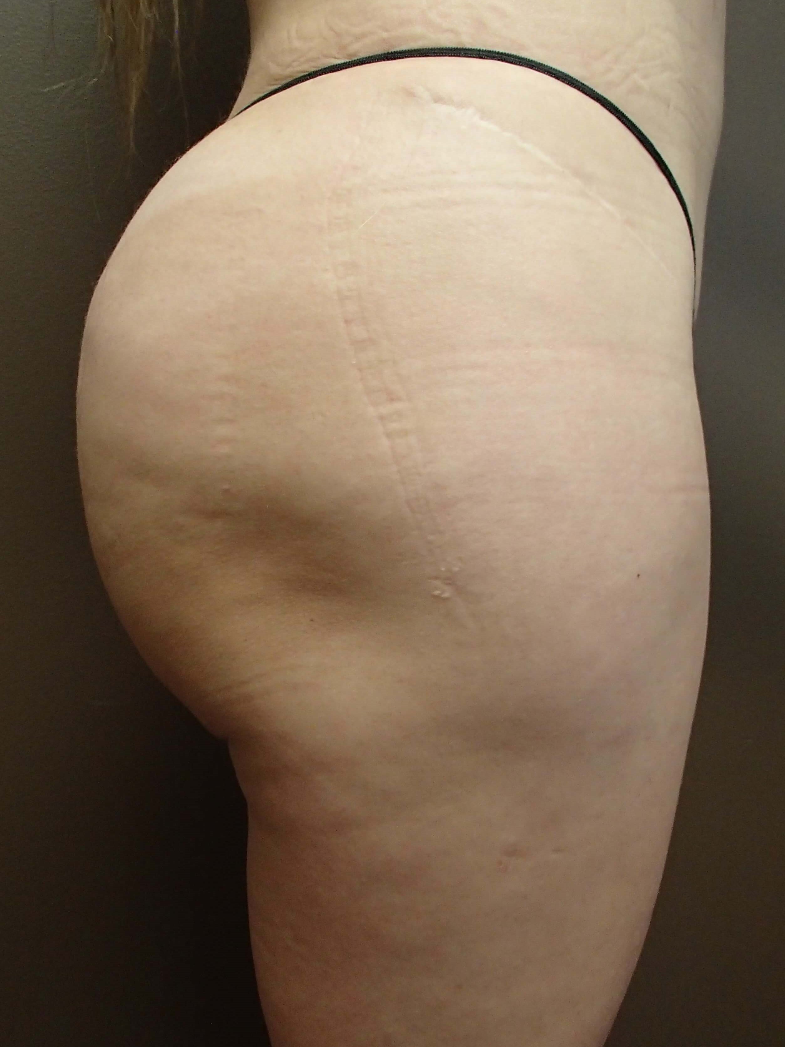 Buttock Augmentation After