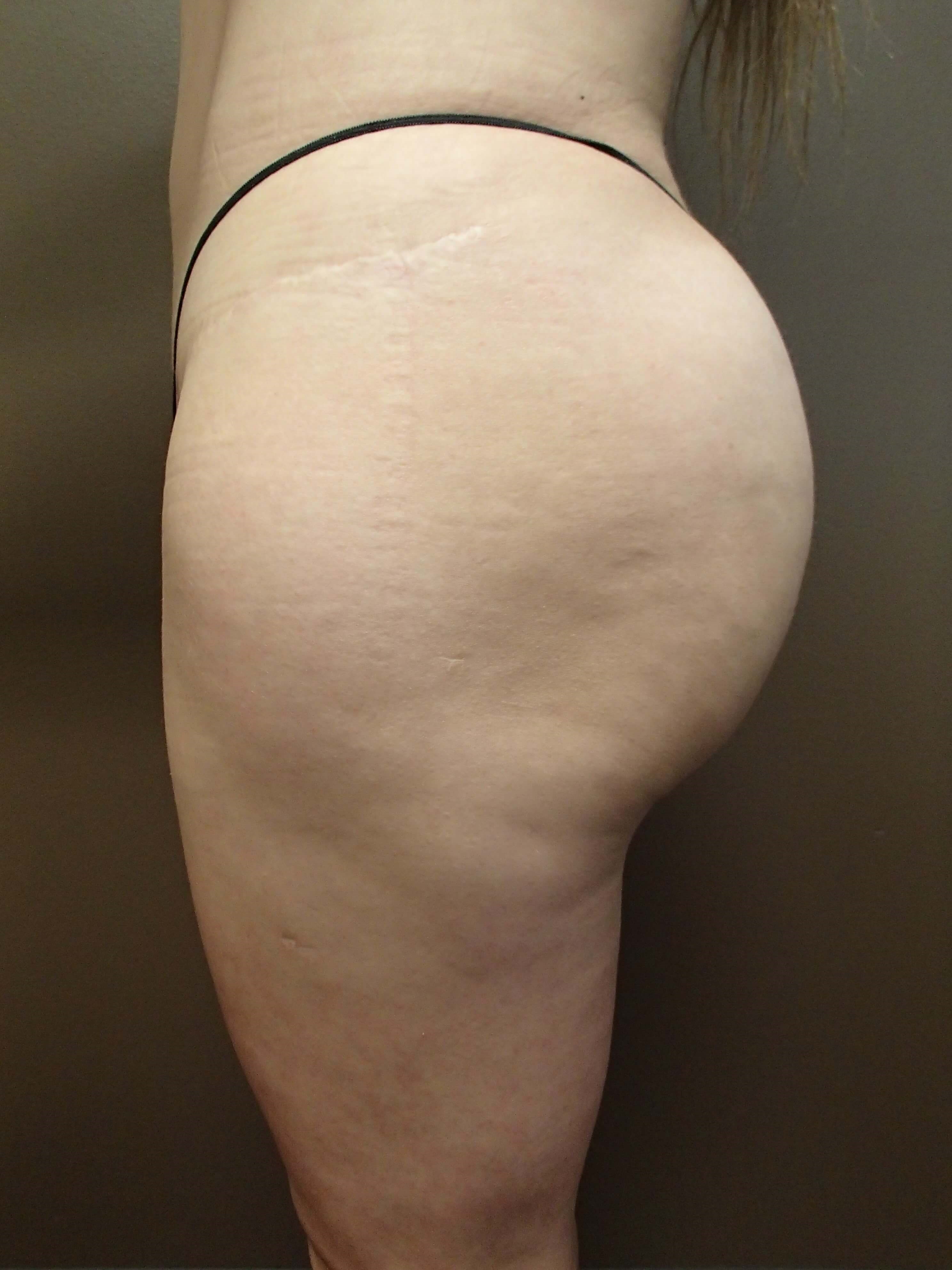 Buttock Augmentation After