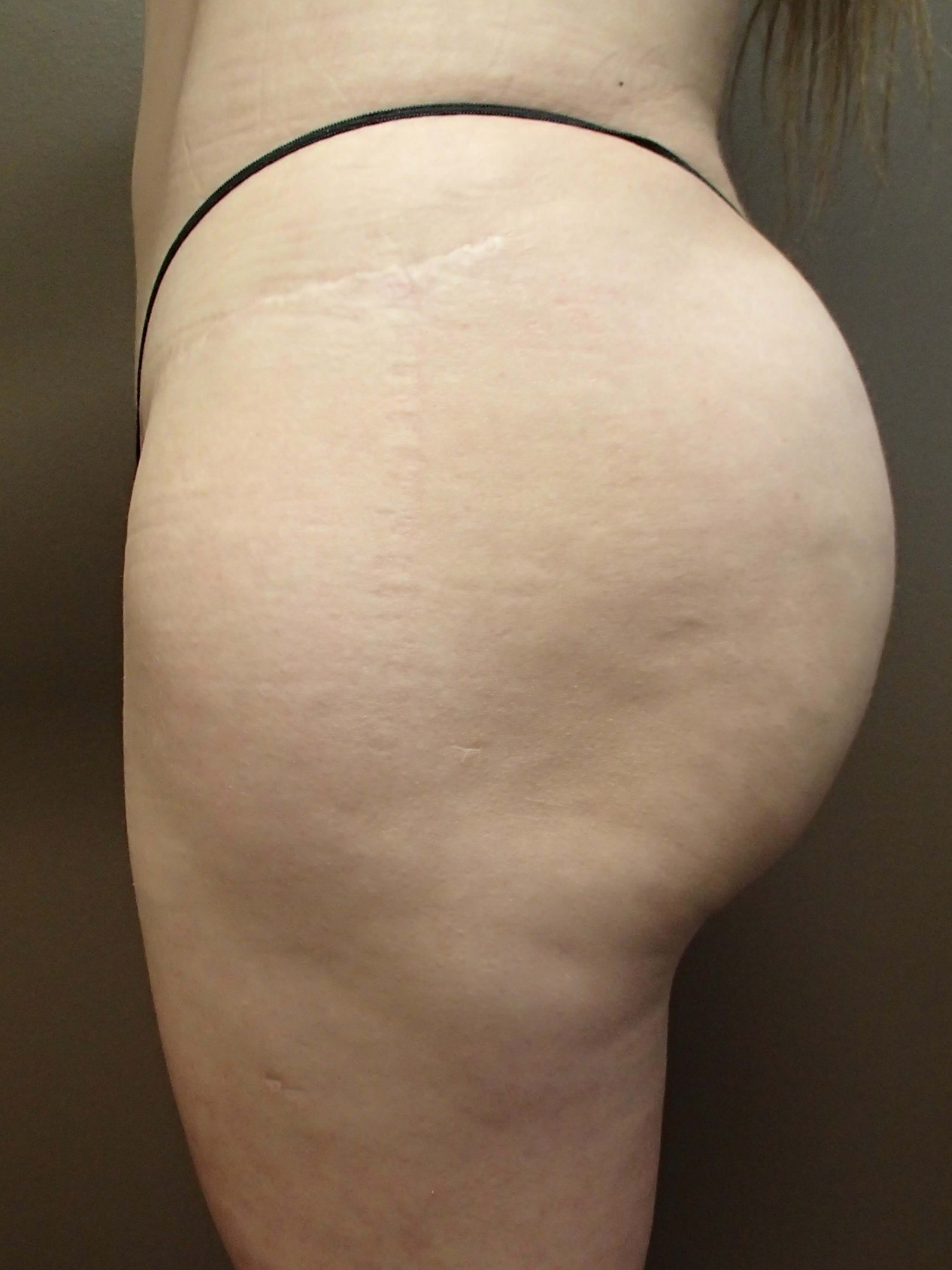 Buttock Augmentation After