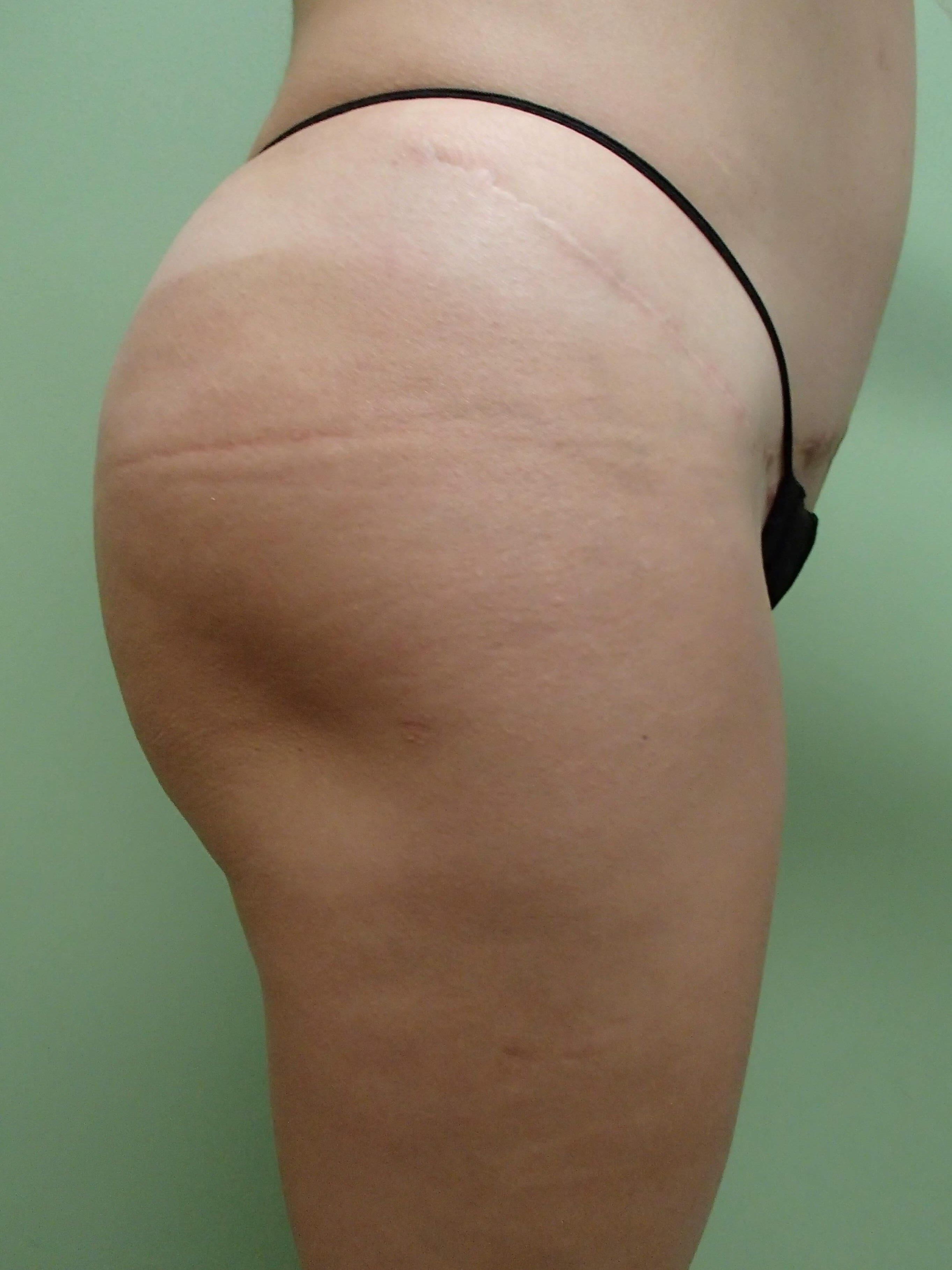 Buttock Augmentation Before