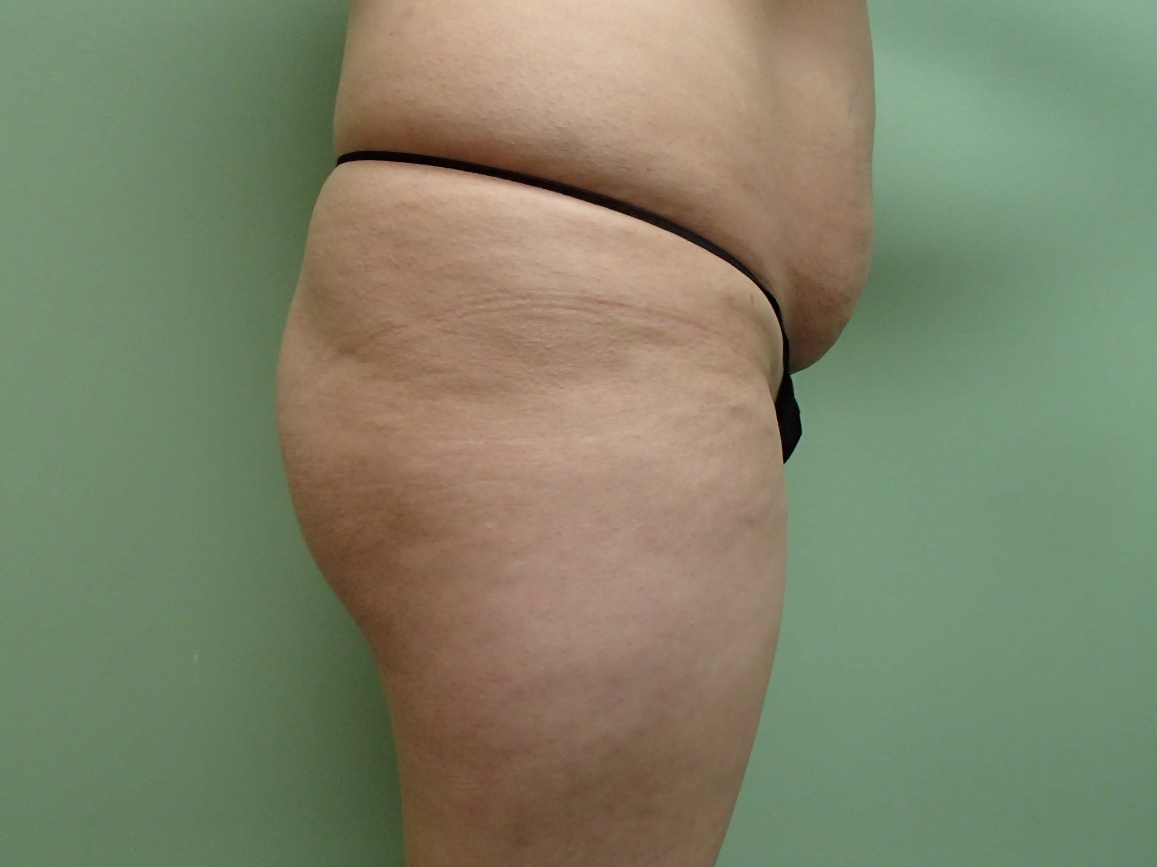 Buttock Augmentation Before