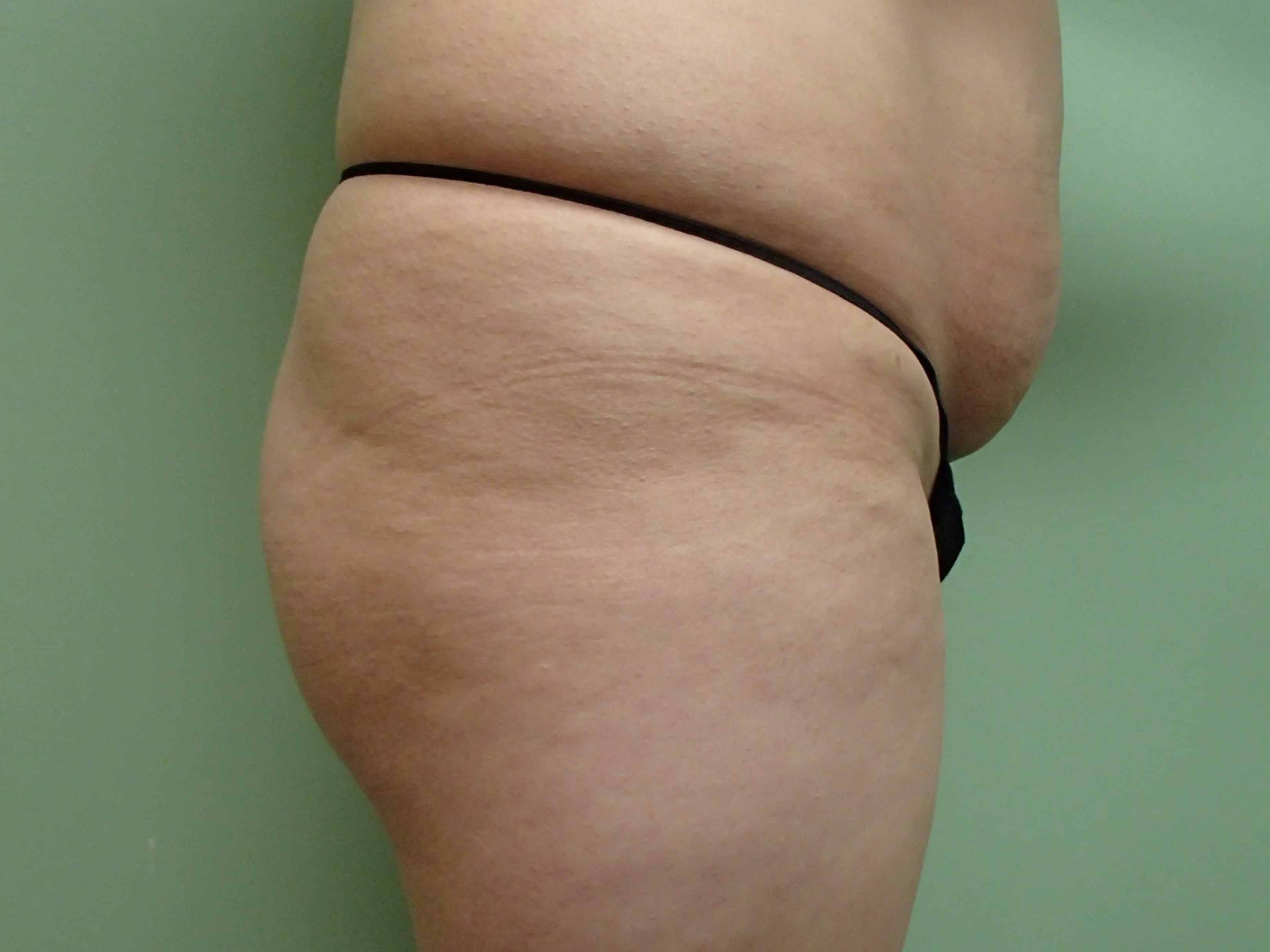 Buttock Augmentation Before