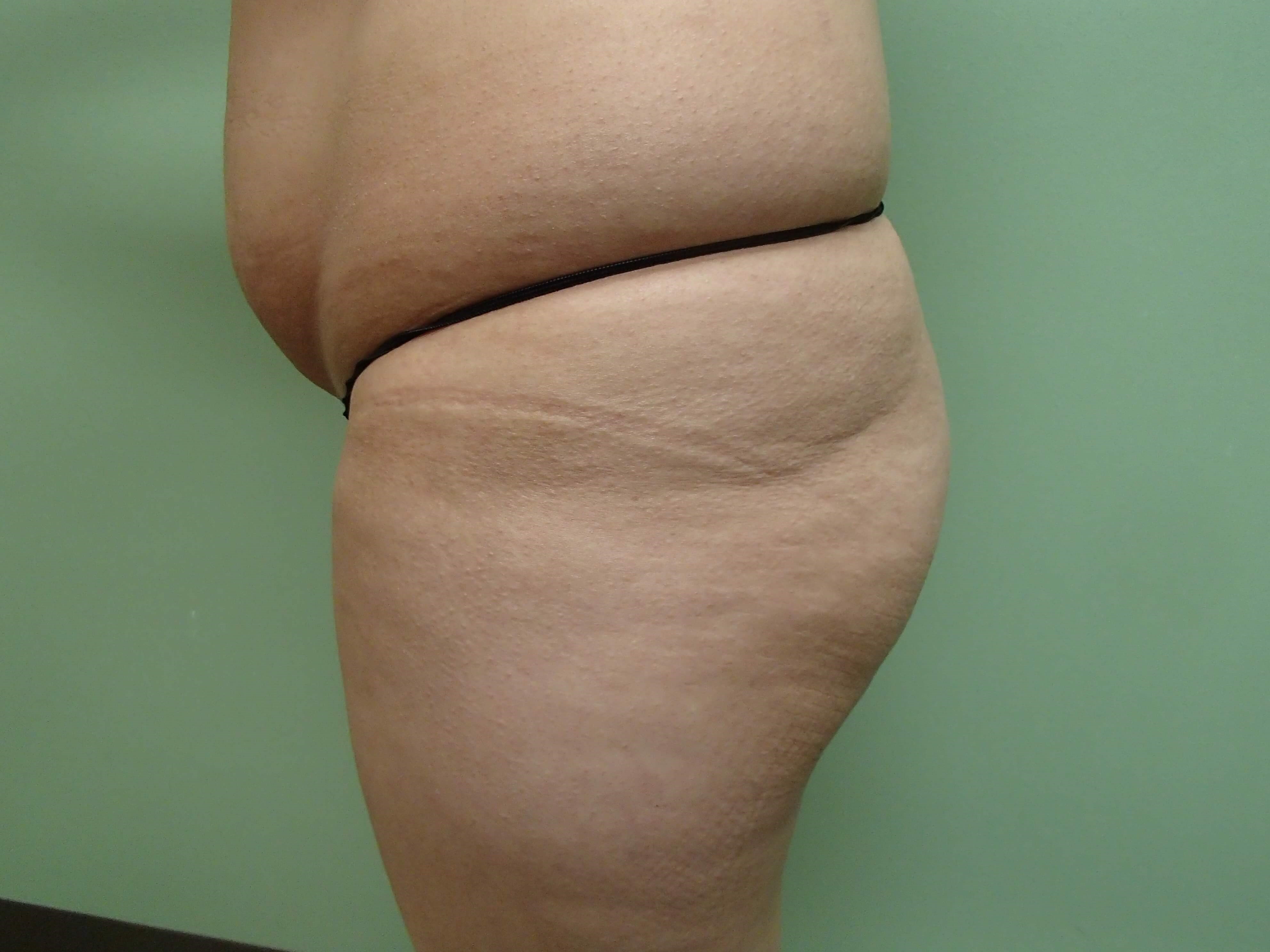 Buttock Augmentation Before