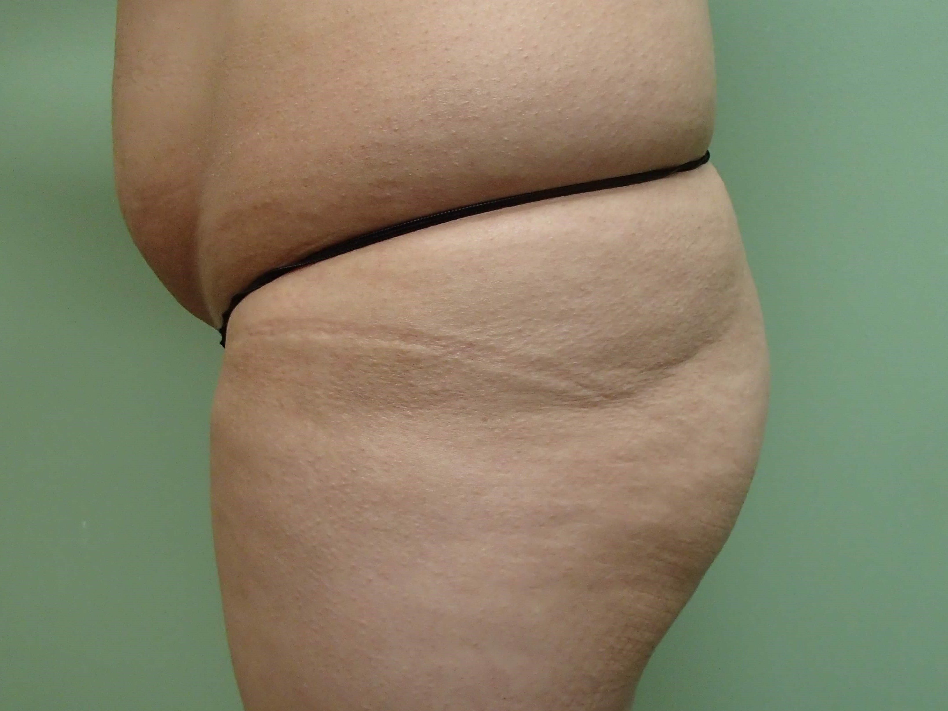 Buttock Augmentation Before