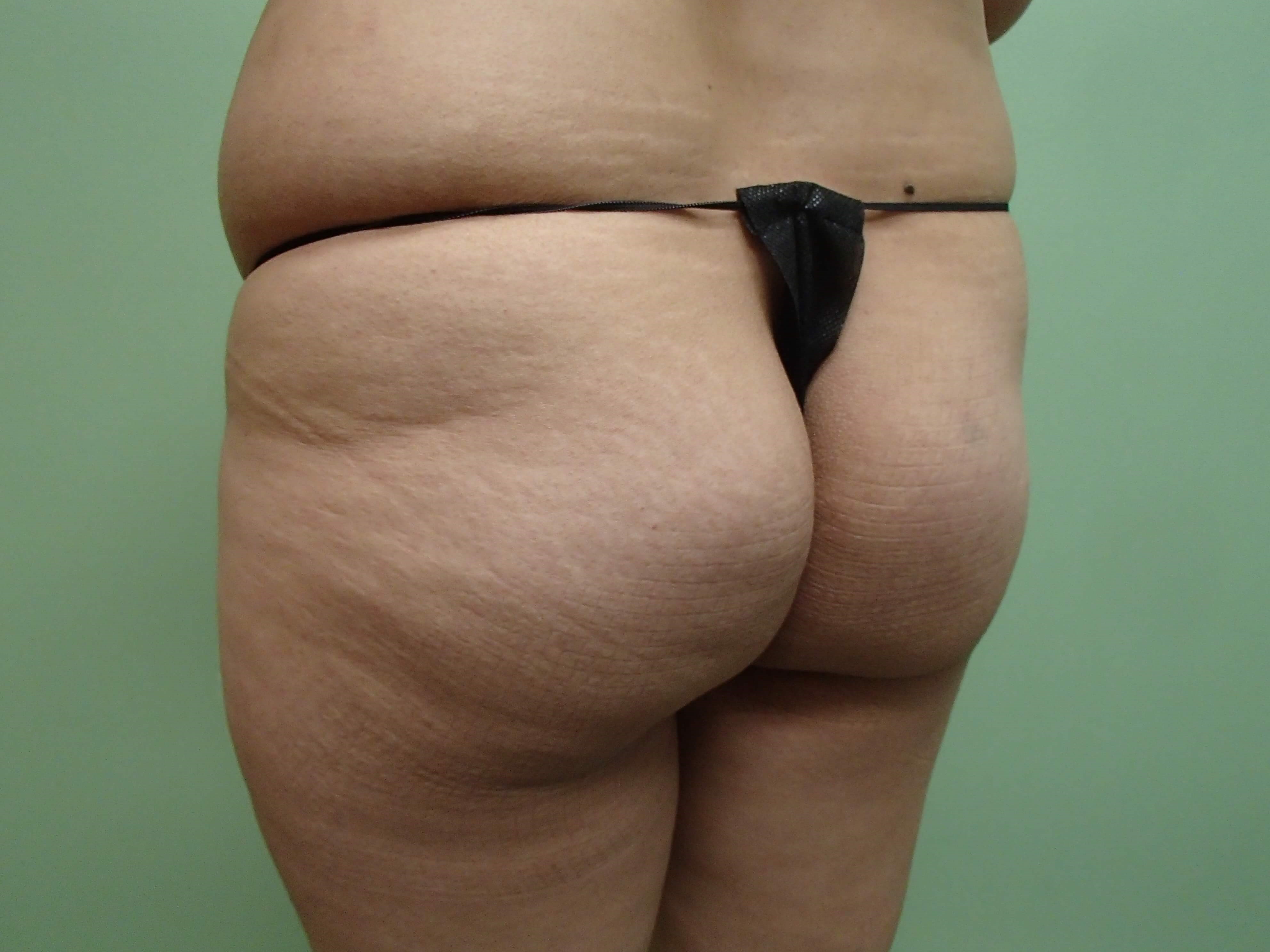 Buttock Augmentation Before