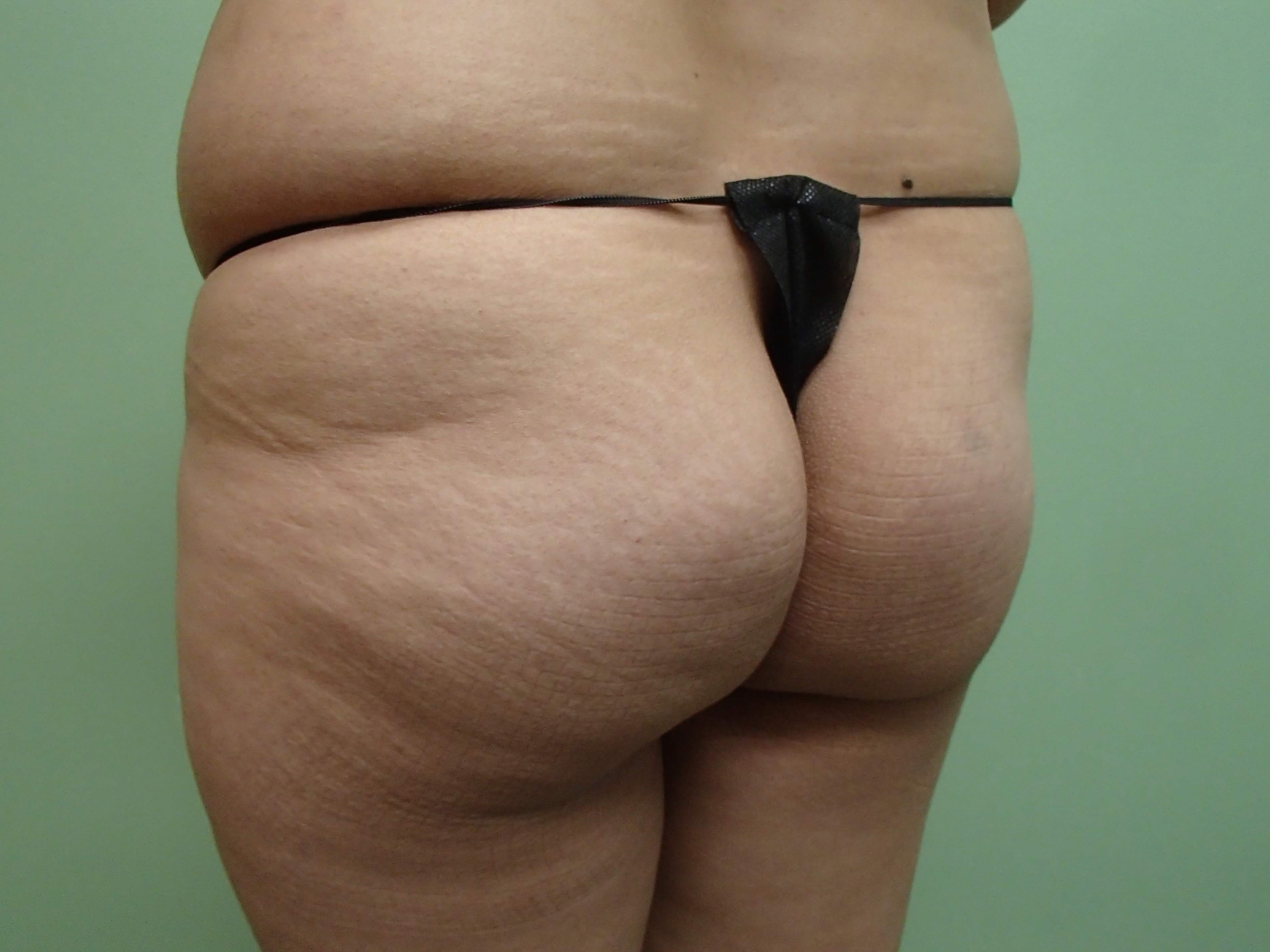 Buttock Augmentation Before