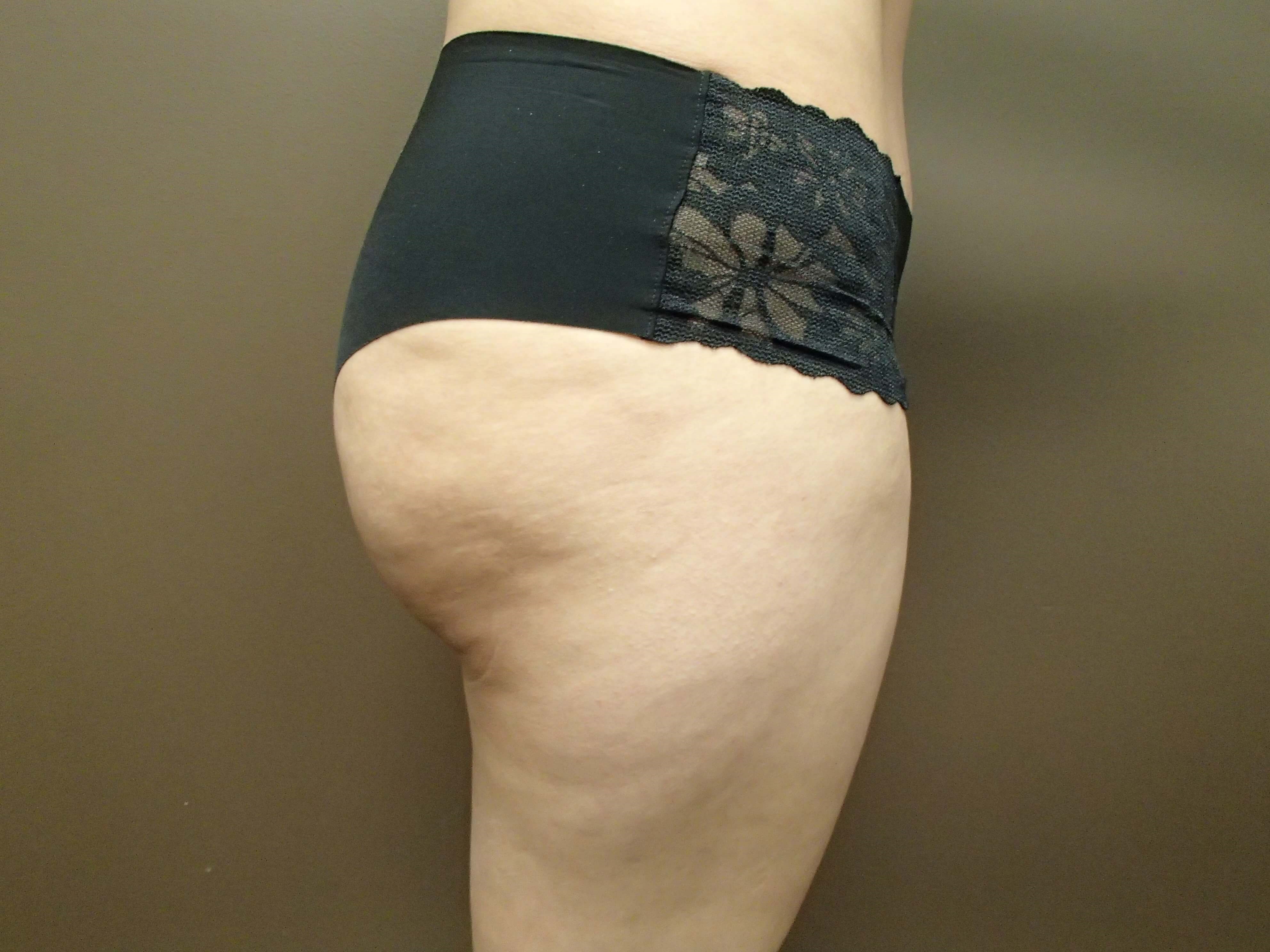 Buttock Augmentation After