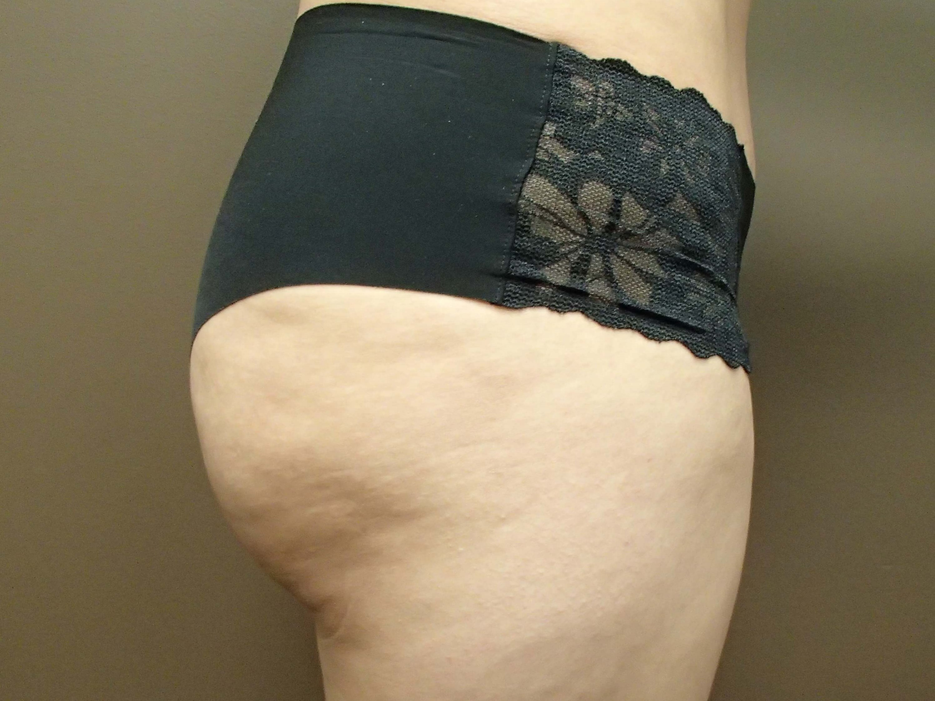 Buttock Augmentation After