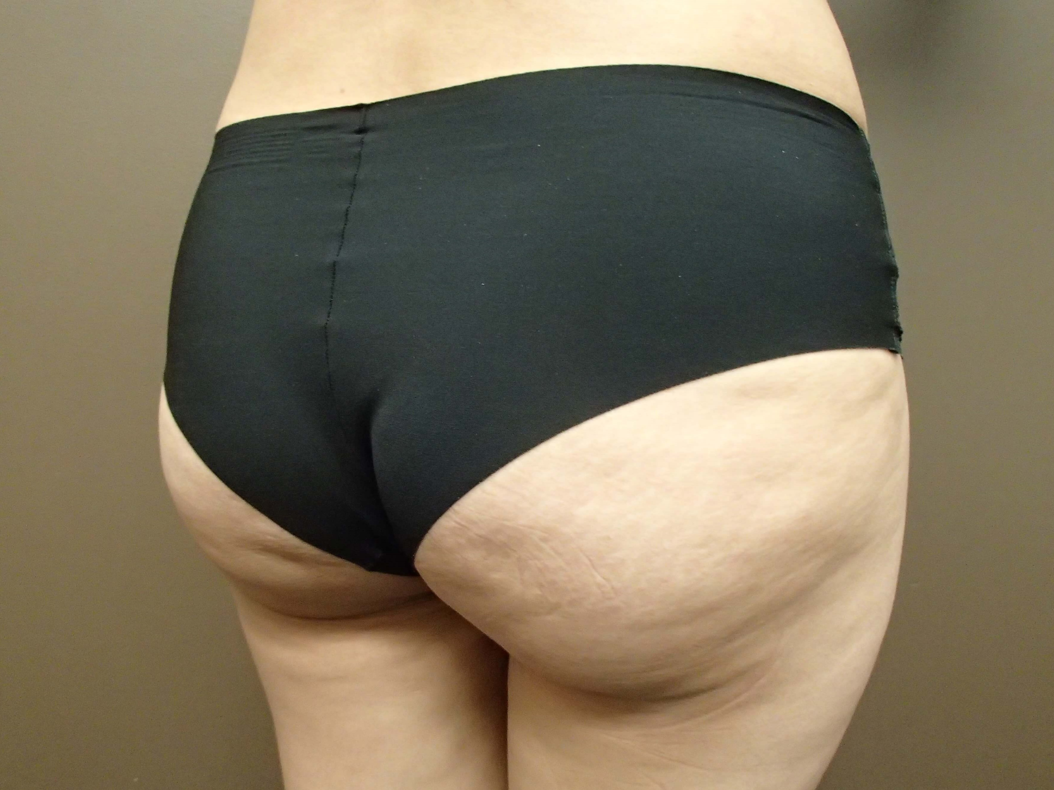 Buttock Augmentation After