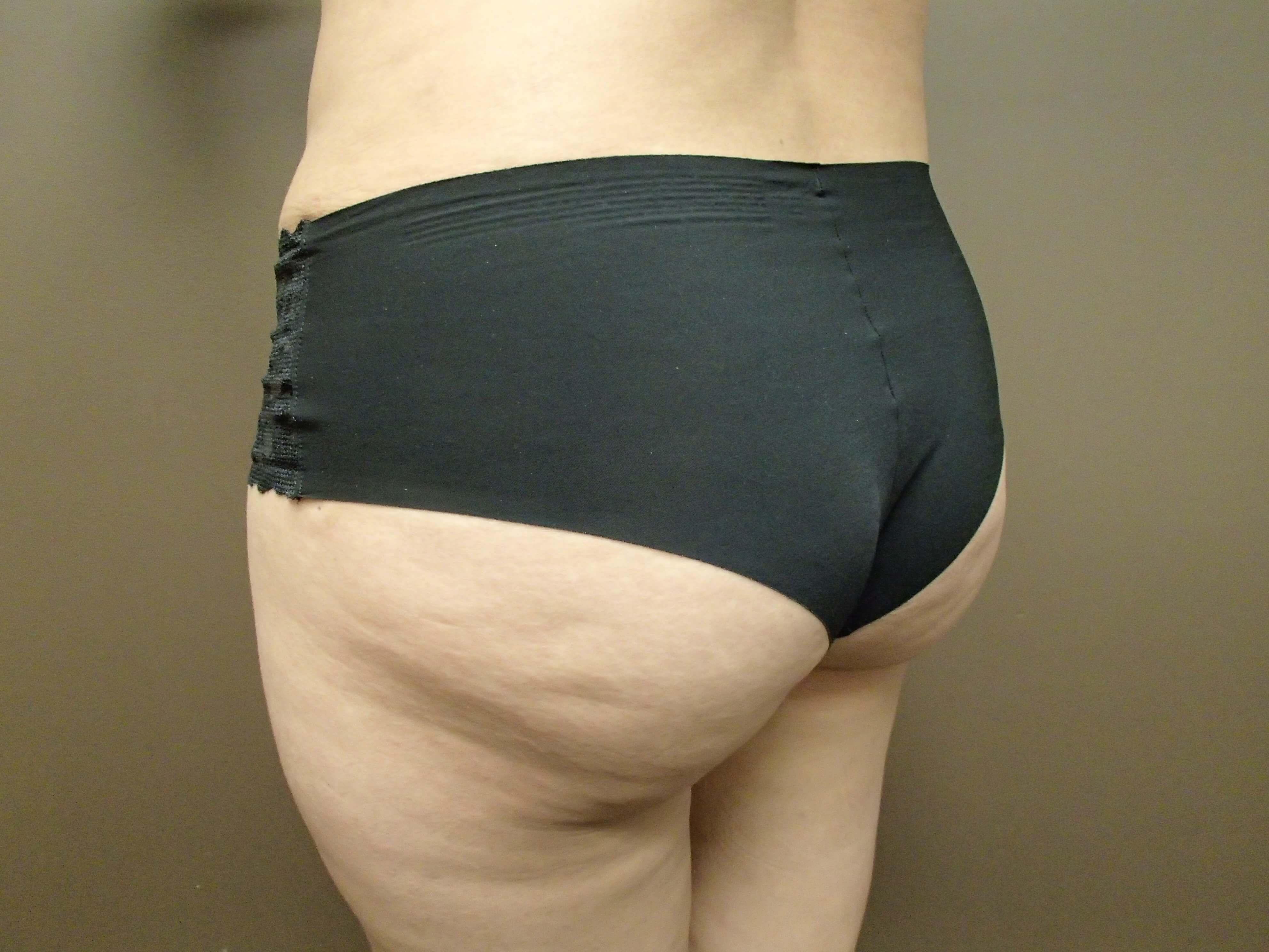Buttock Augmentation After