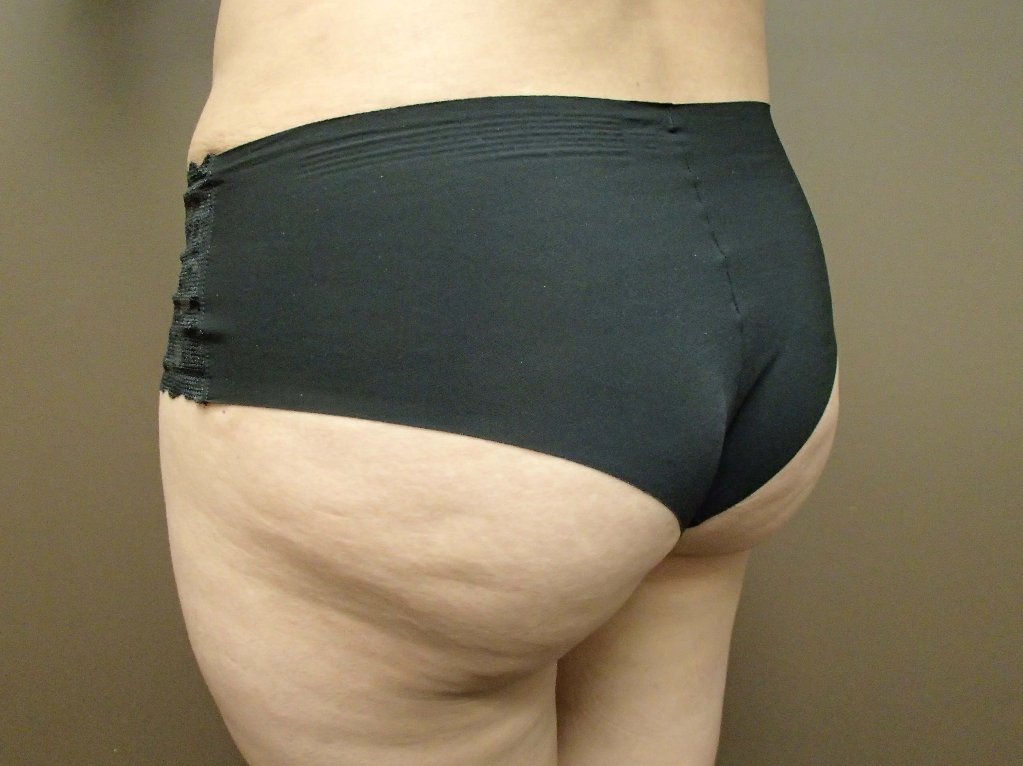 Buttock Augmentation After