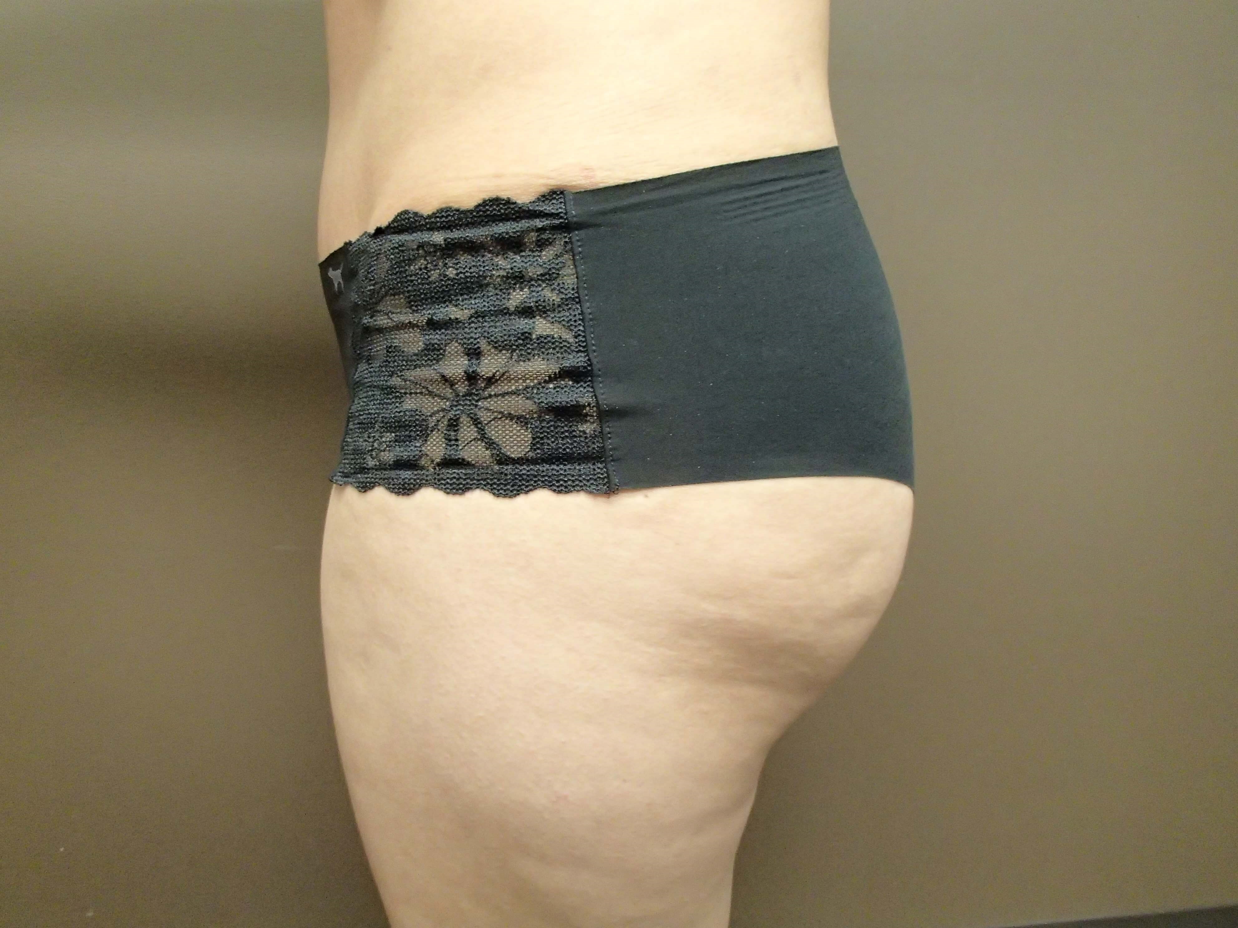 Buttock Augmentation After