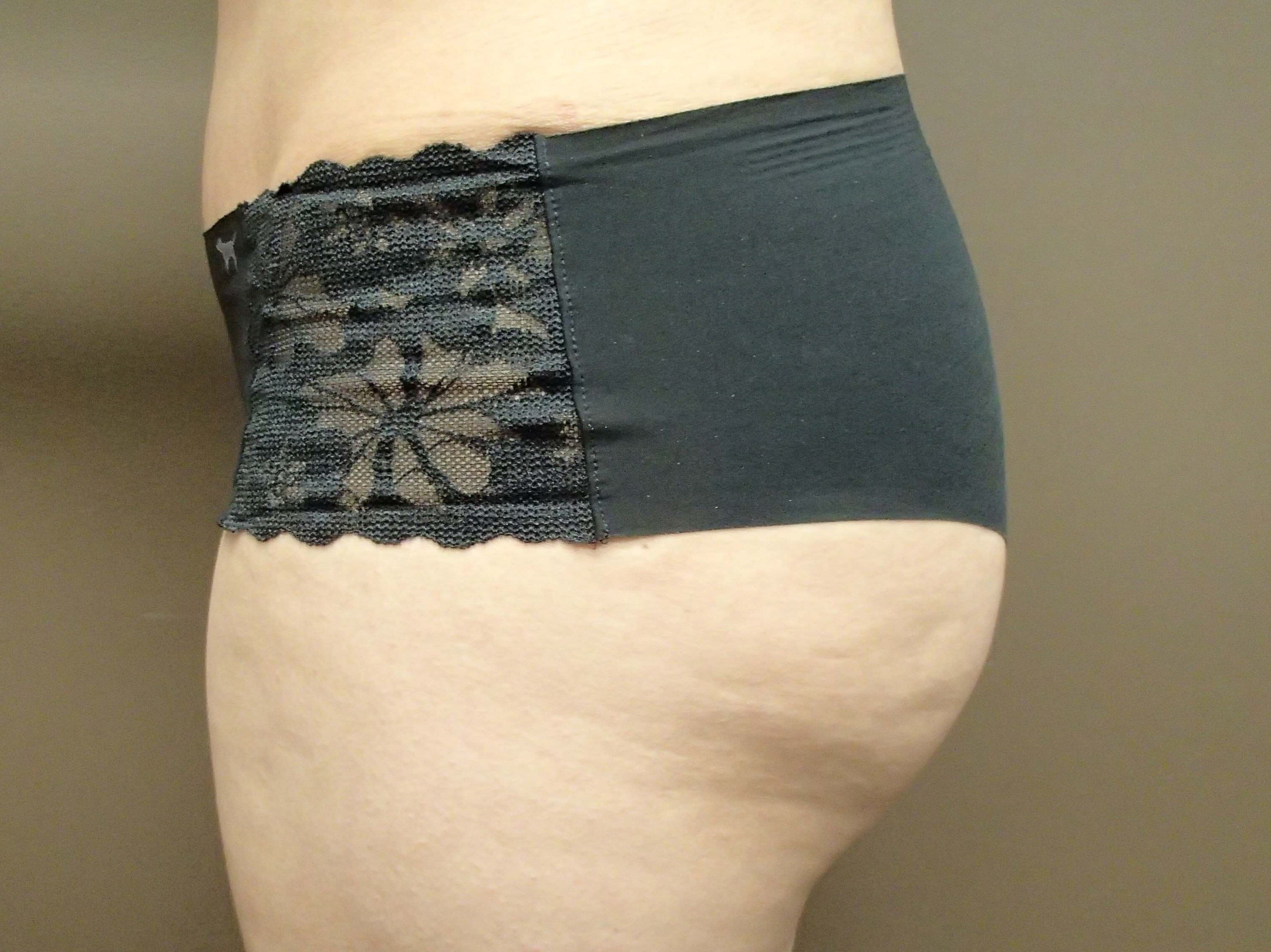 Buttock Augmentation After