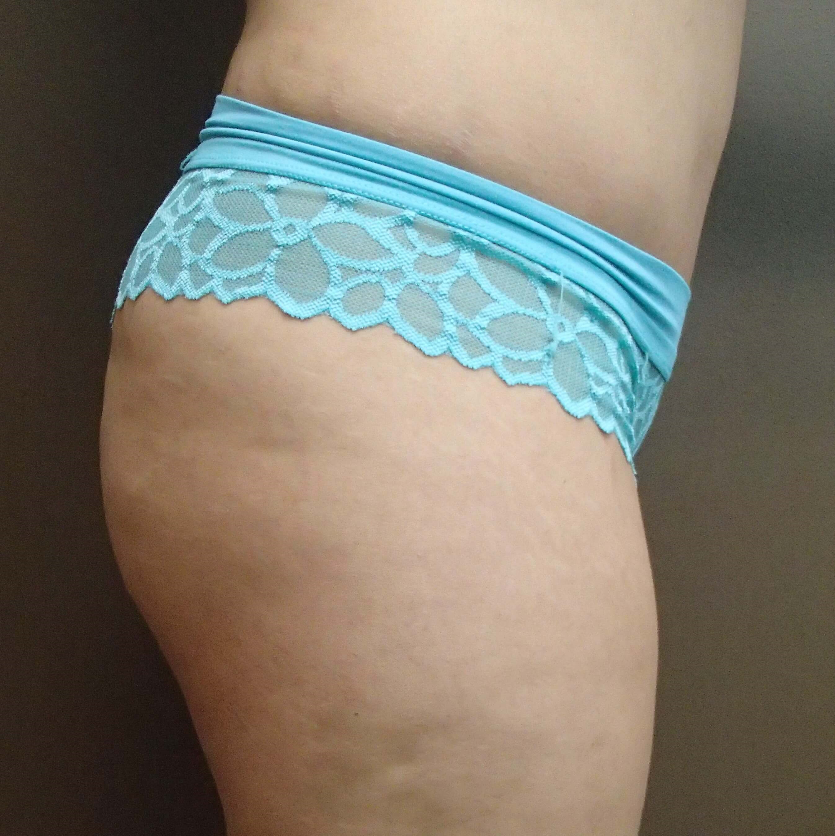 Buttock Augmentation Before