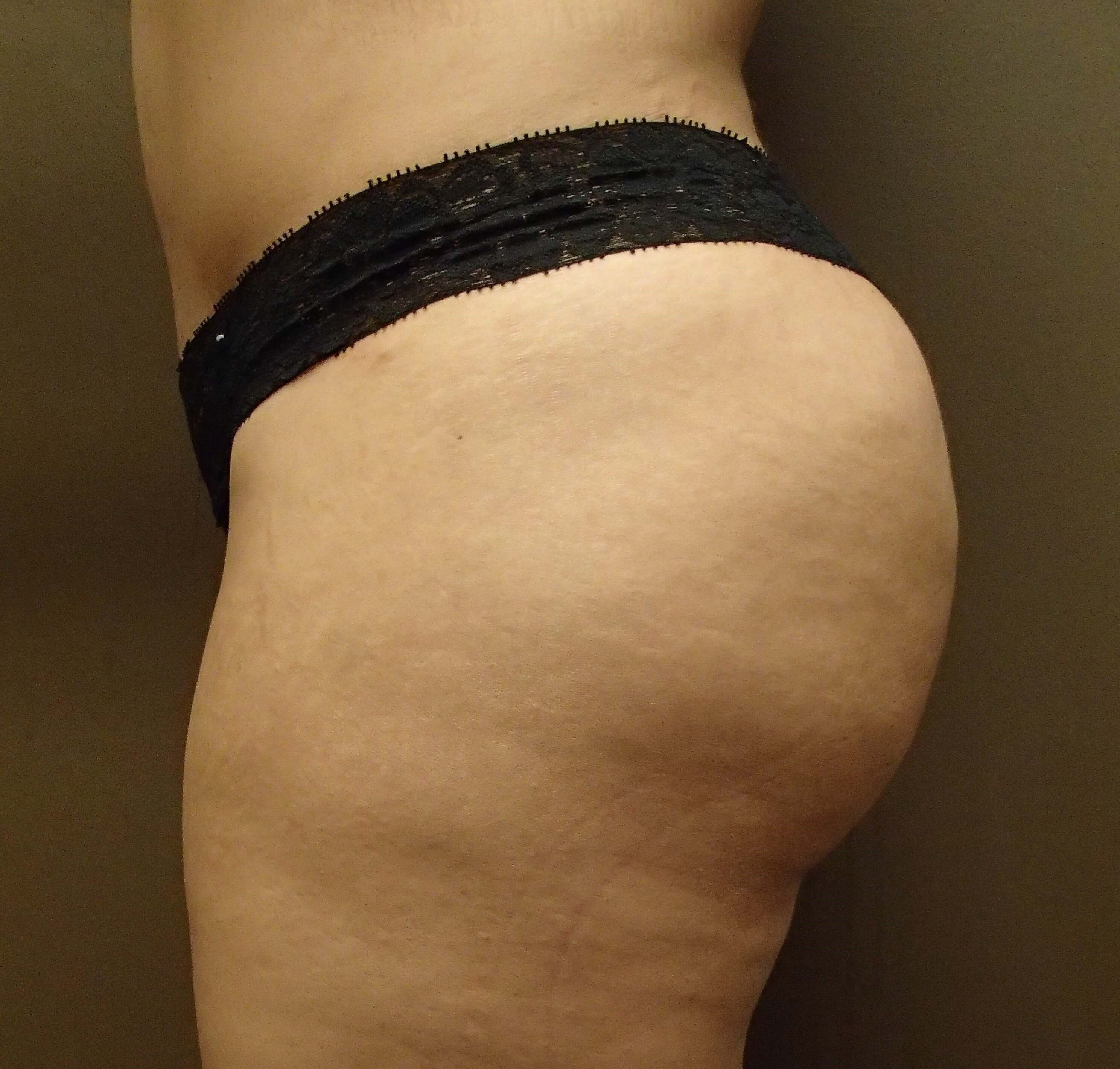 Buttock Augmentation After