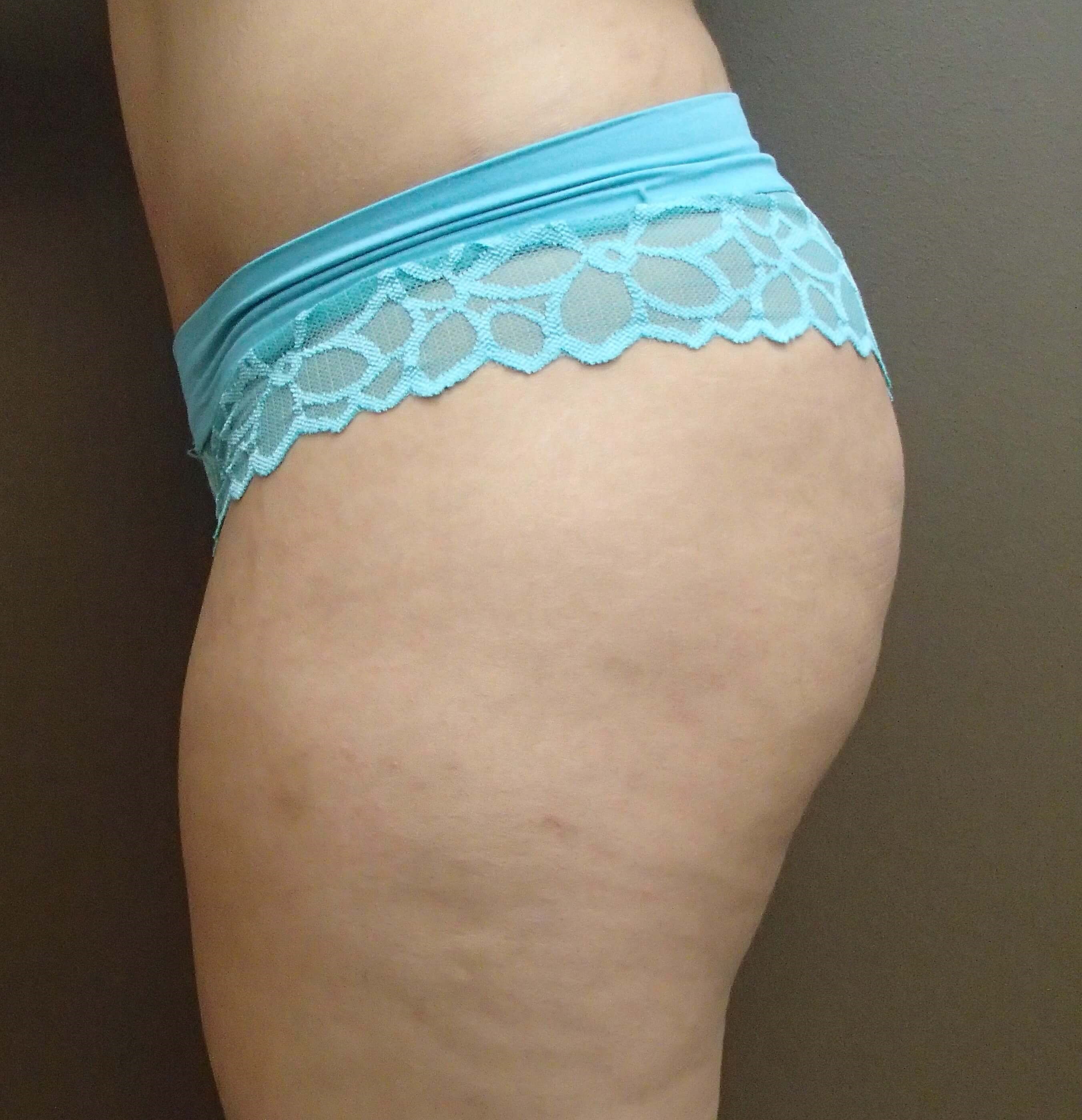 Buttock Augmentation Before