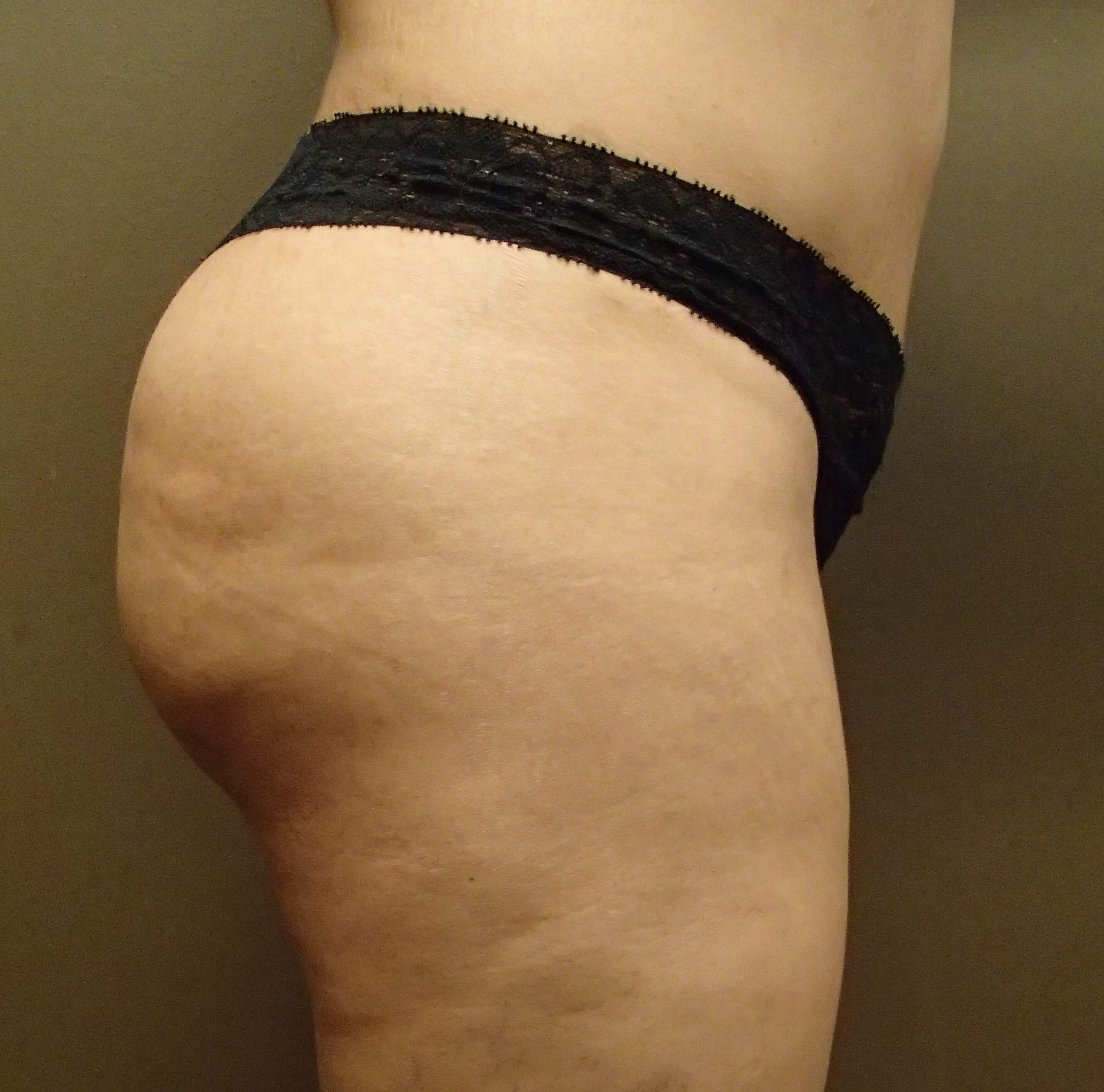 Buttock Augmentation After