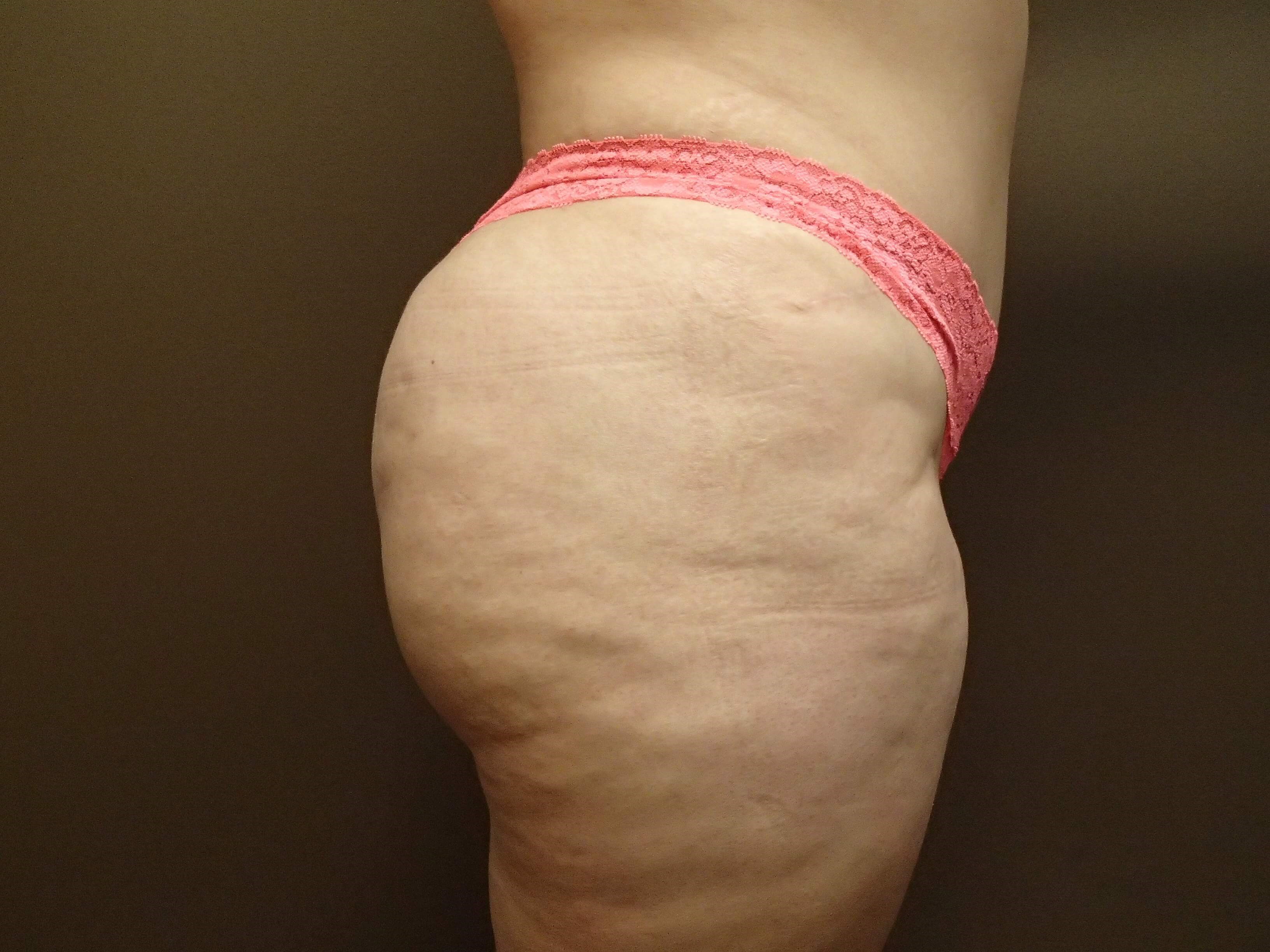 Buttock Augmentation After