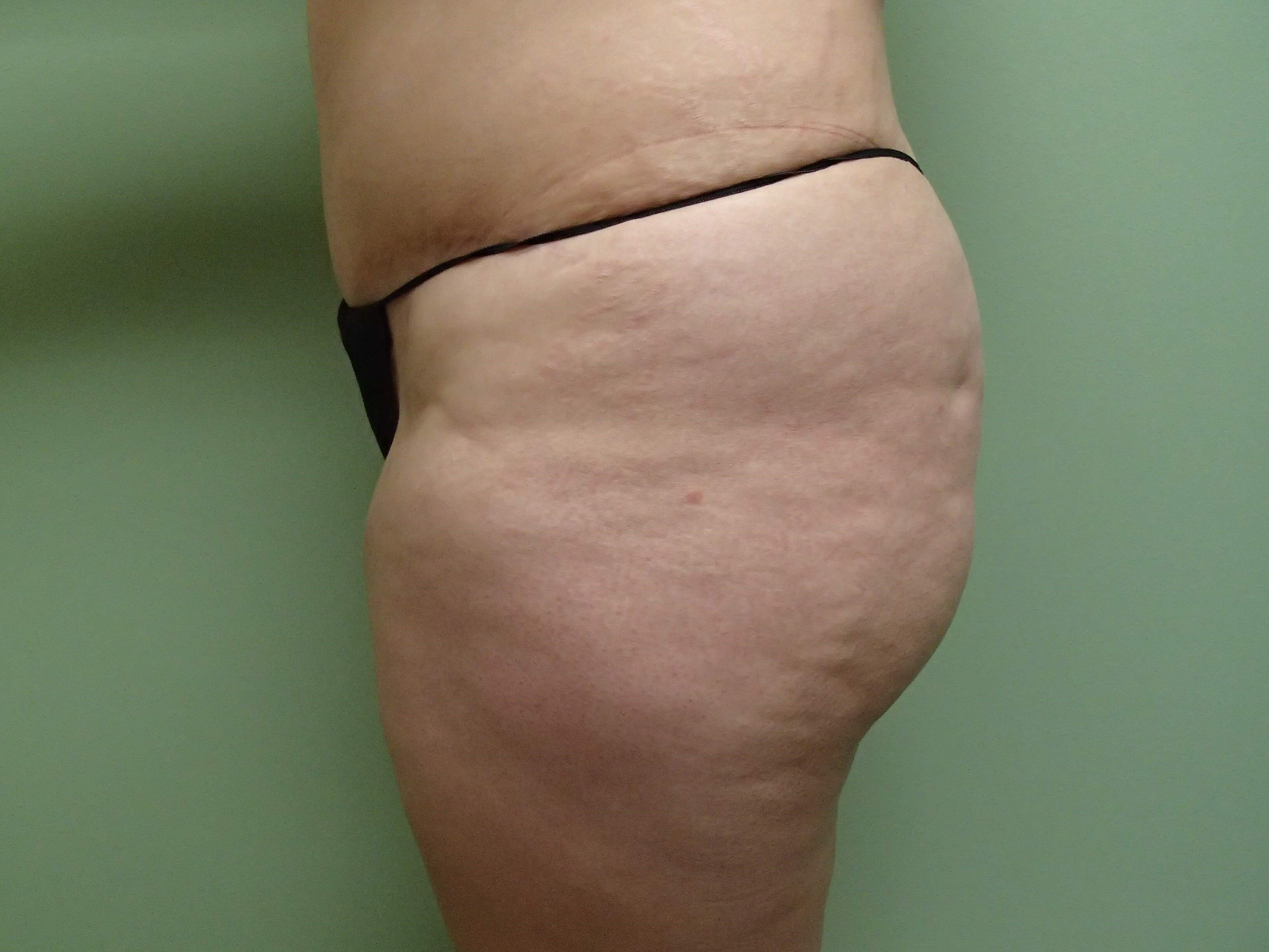Buttock Augmentation Before
