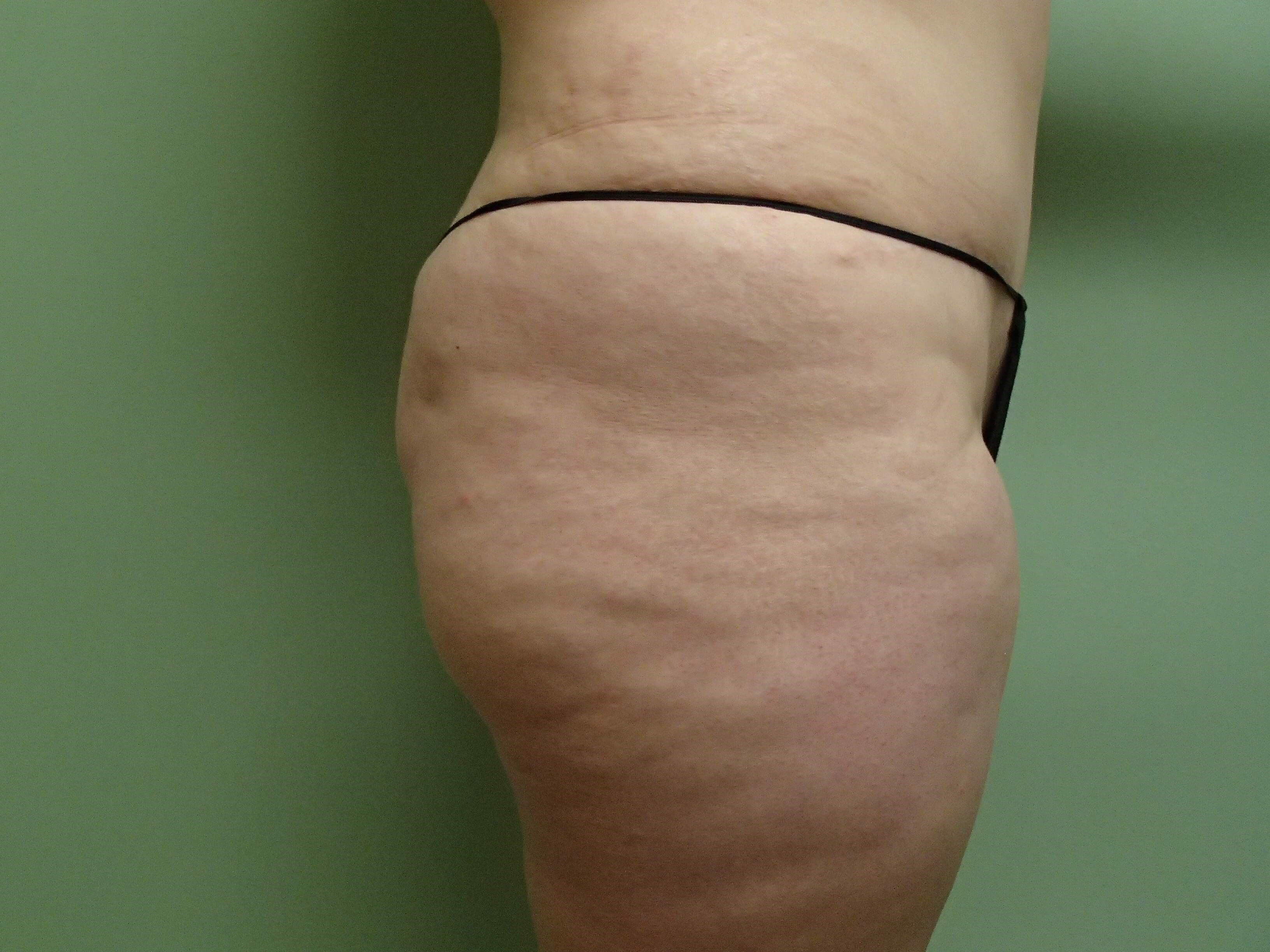 Buttock Augmentation Before
