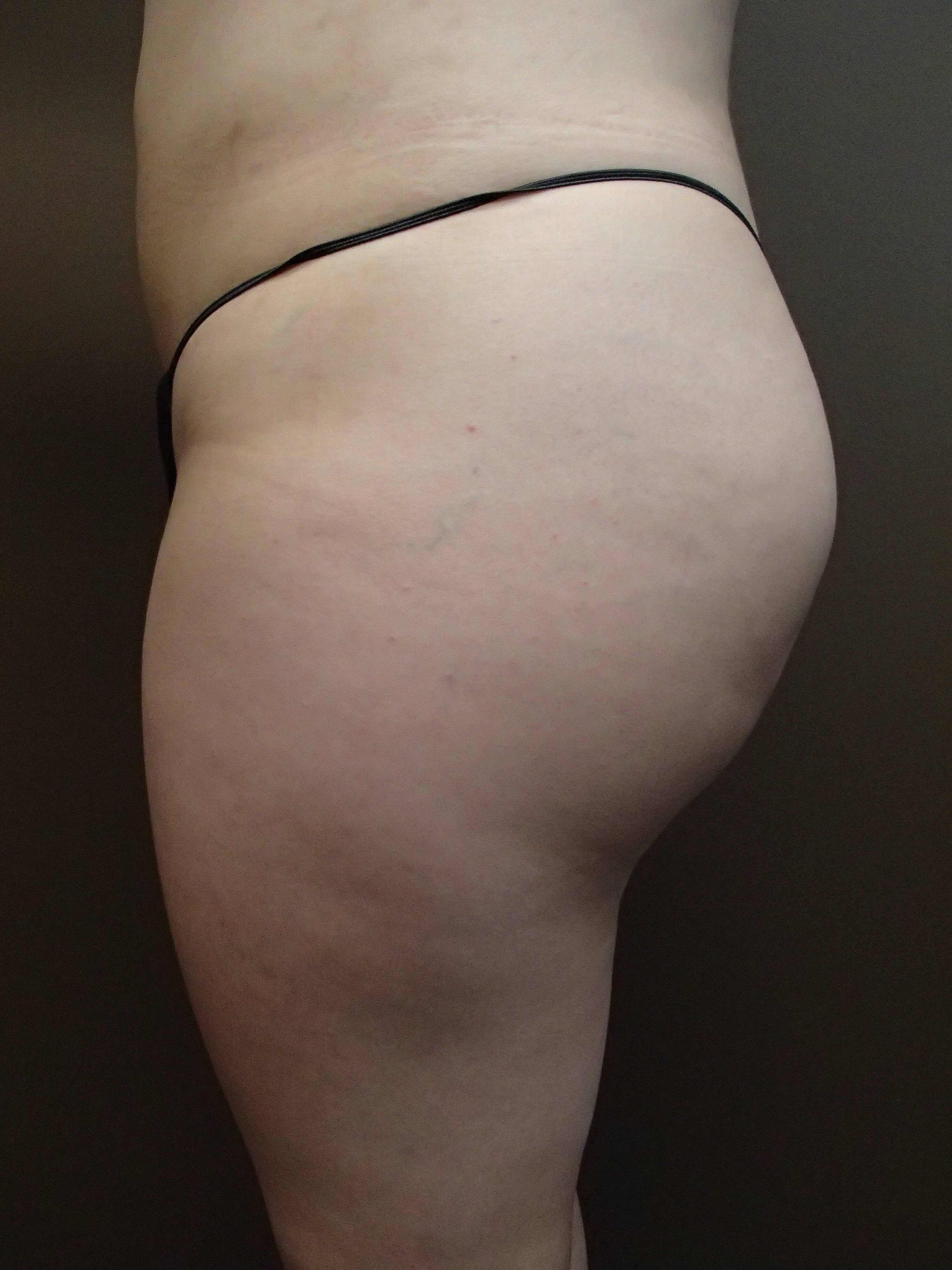 Buttock Augmentation After