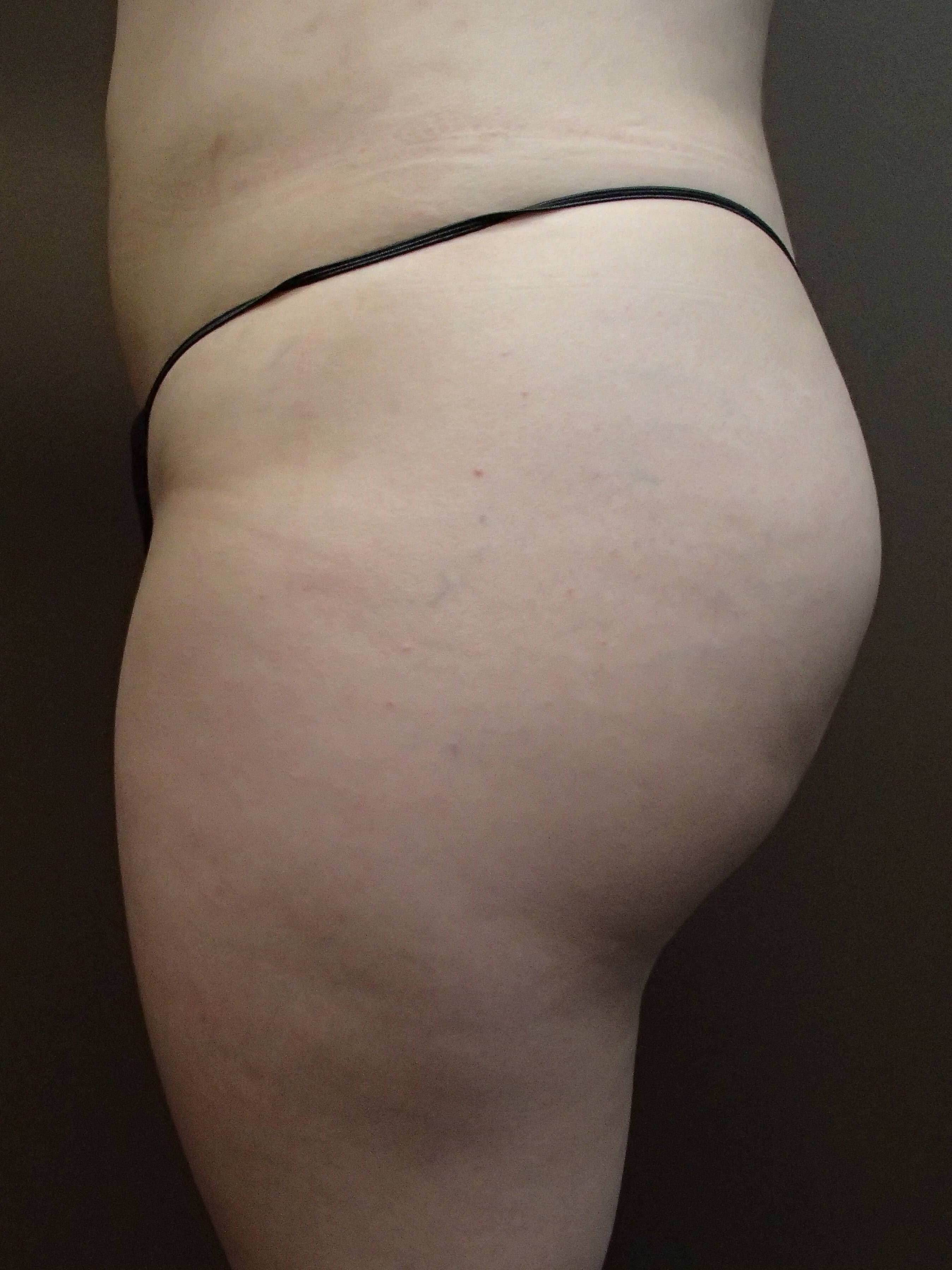 Buttock Augmentation After