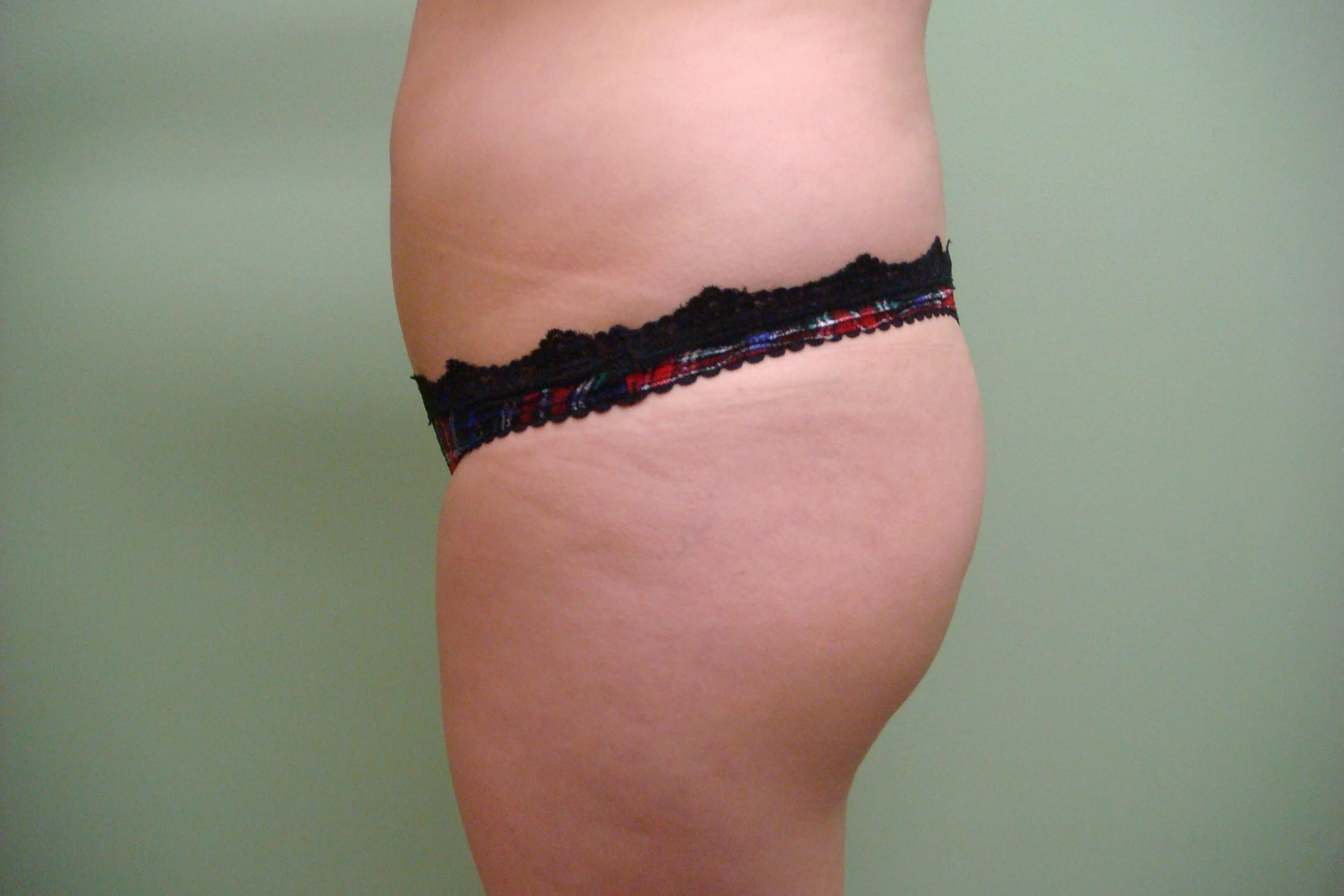 Buttock Augmentation Before